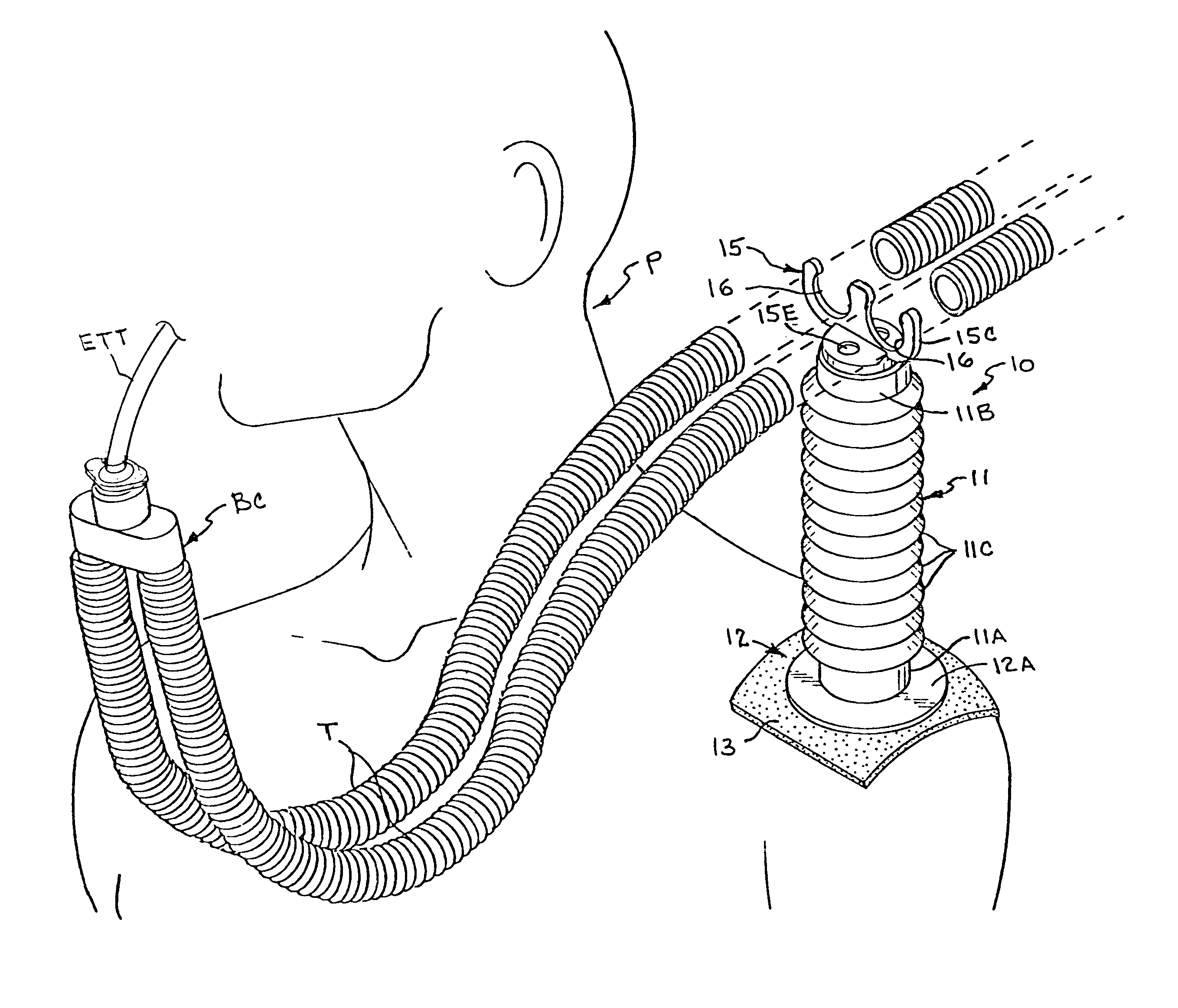 Anesthesia breathing circuit tube support