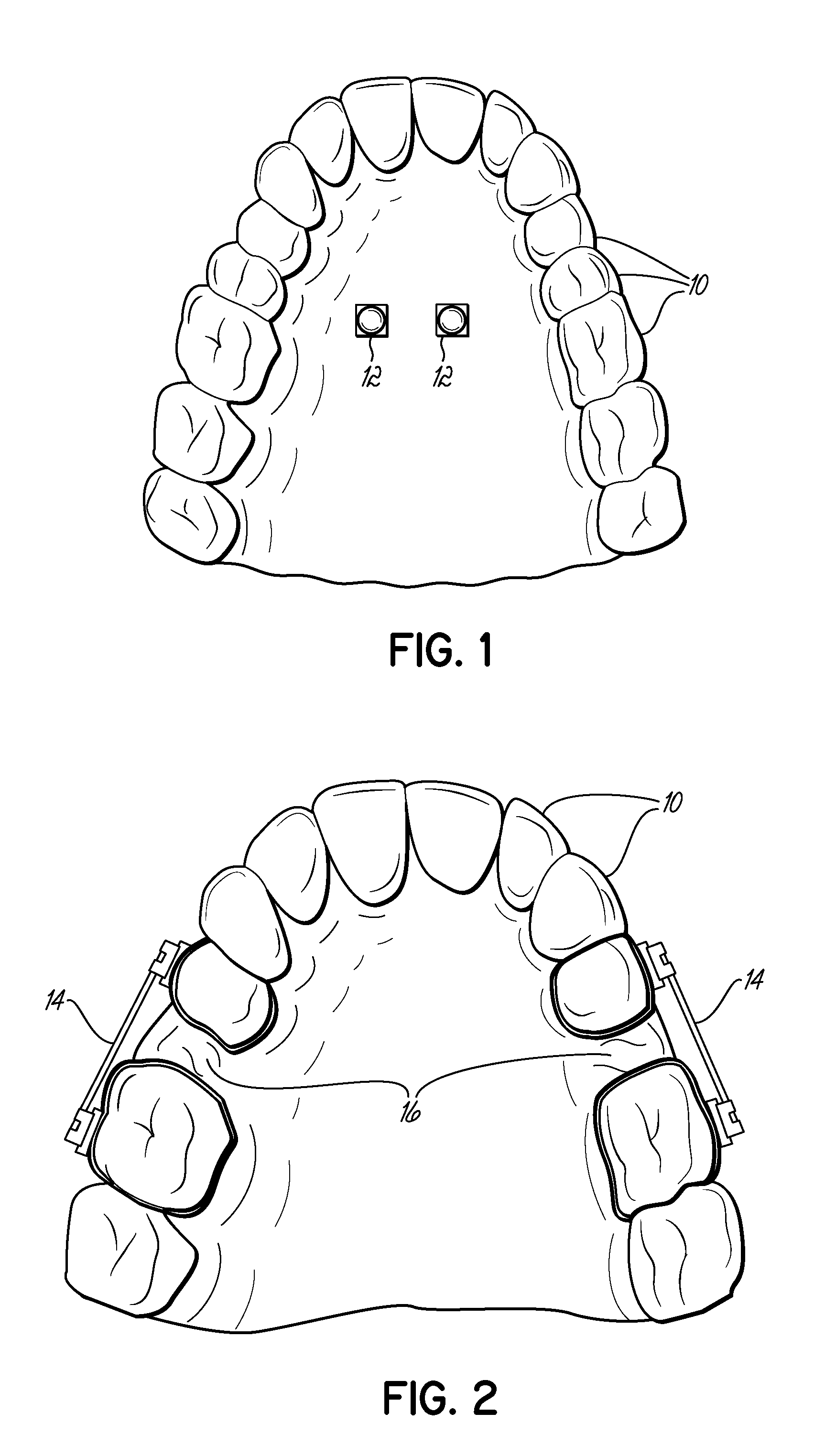 Fabricating custom extensions to thermoformed aligners
