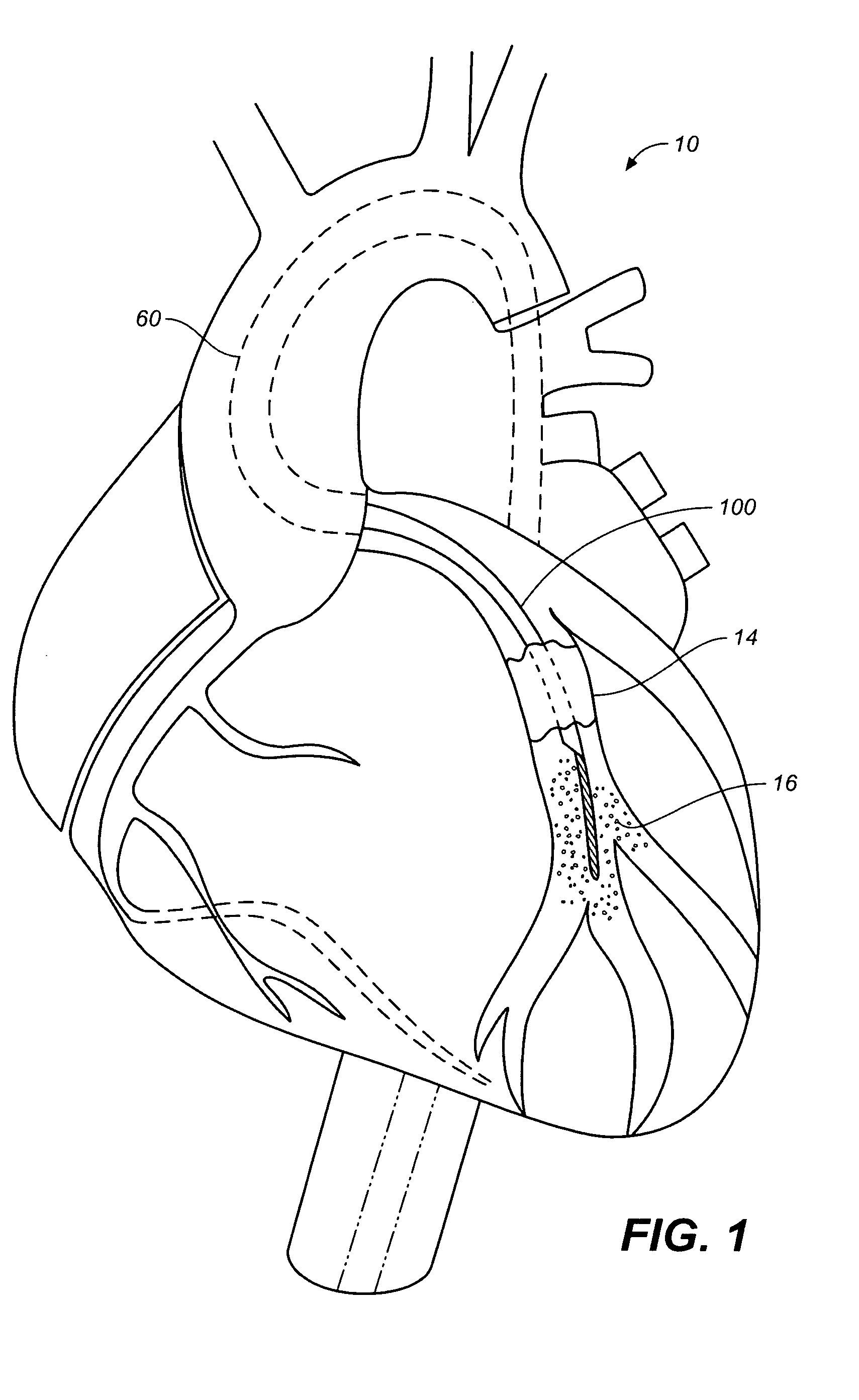 Integrated device for ischemic treatment