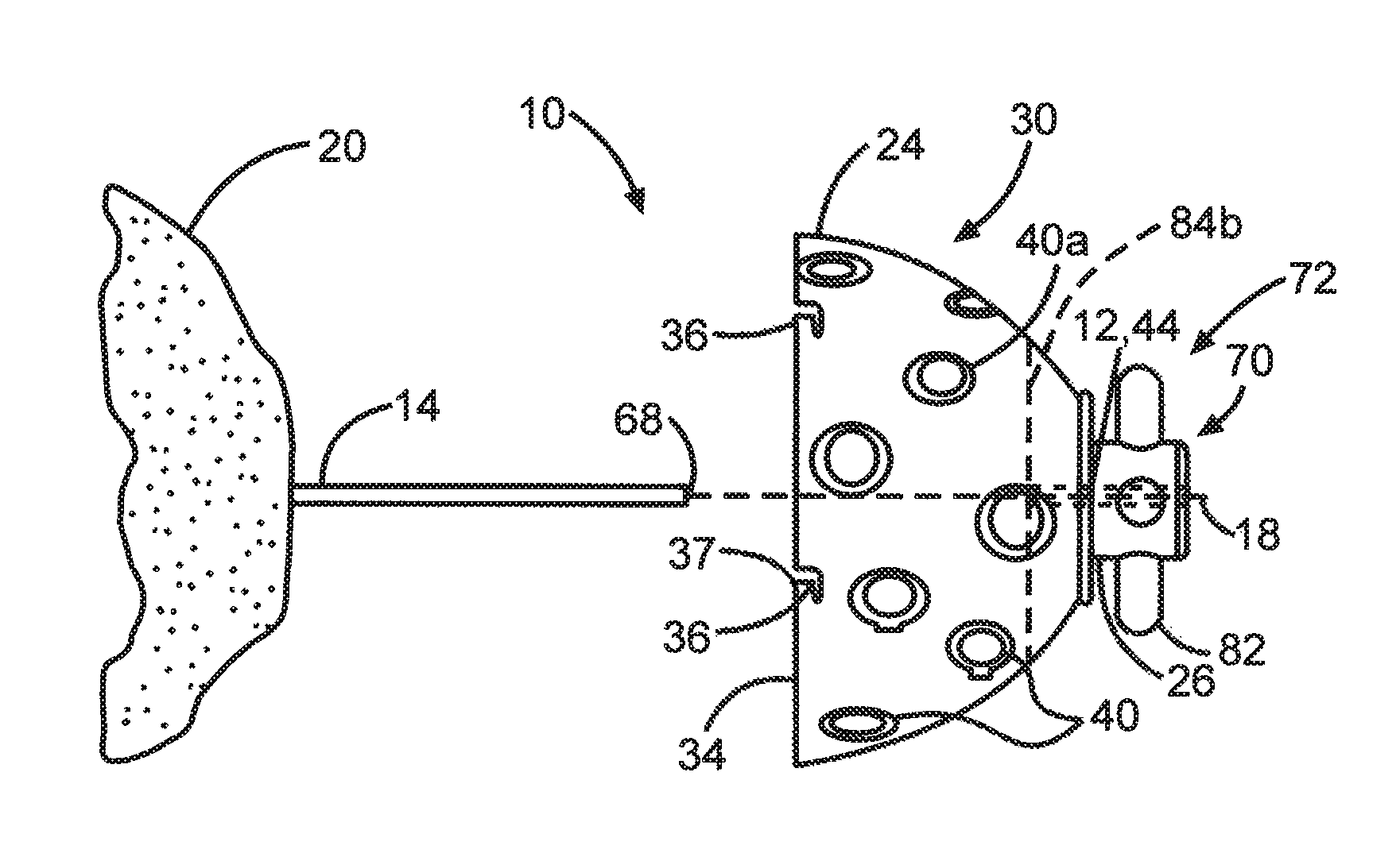 Guided reamer system for reshaping bone