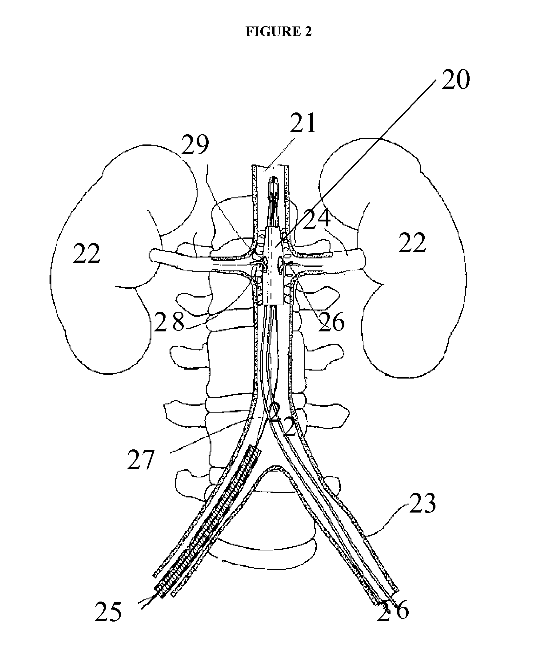 Method and device for graft fenestration