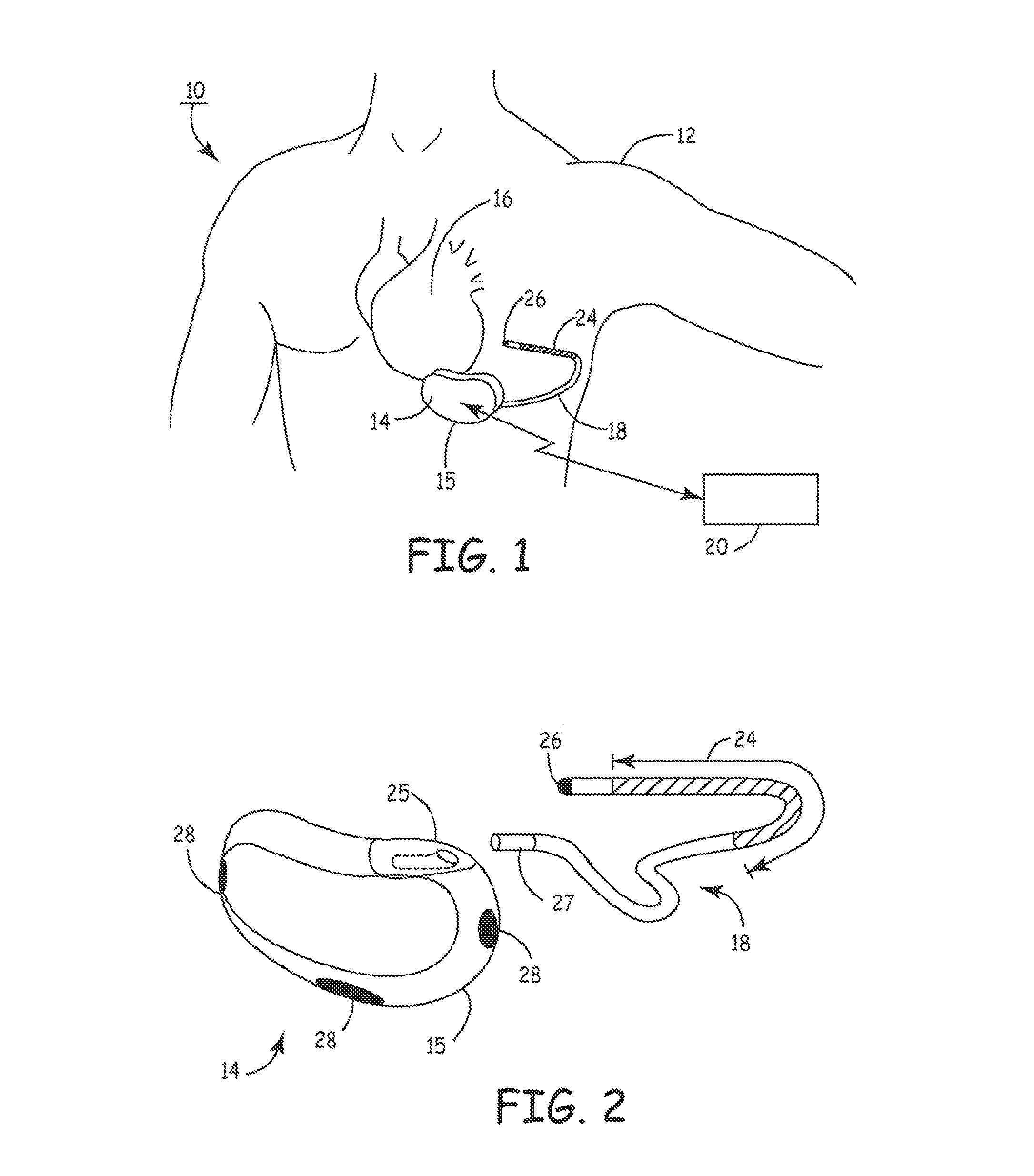 Method and apparatus for detecting arrhythmias in a subcutaneous medical device