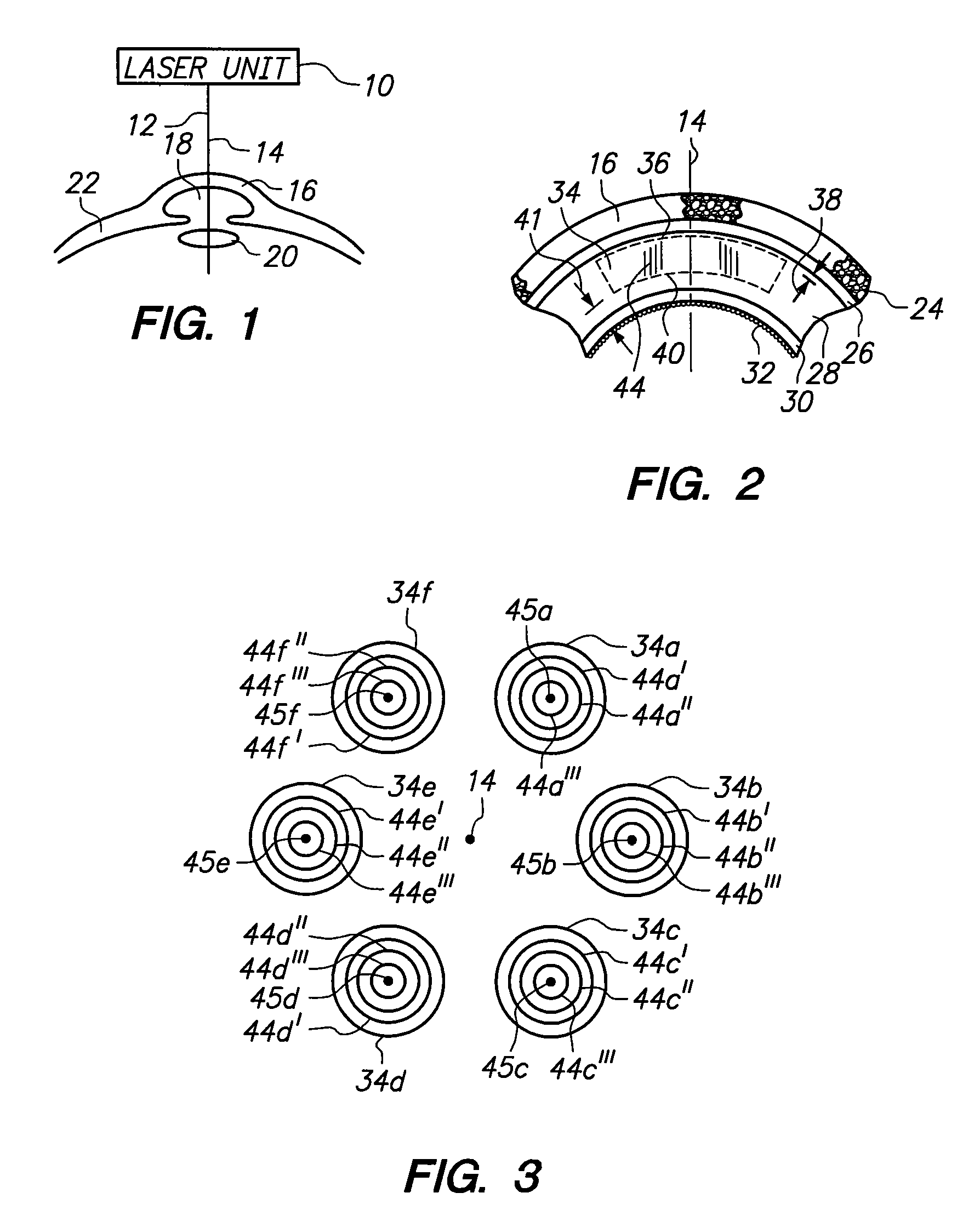 System and method for correcting higher order aberrations with changes in intrastromal biomechanical stress distributions