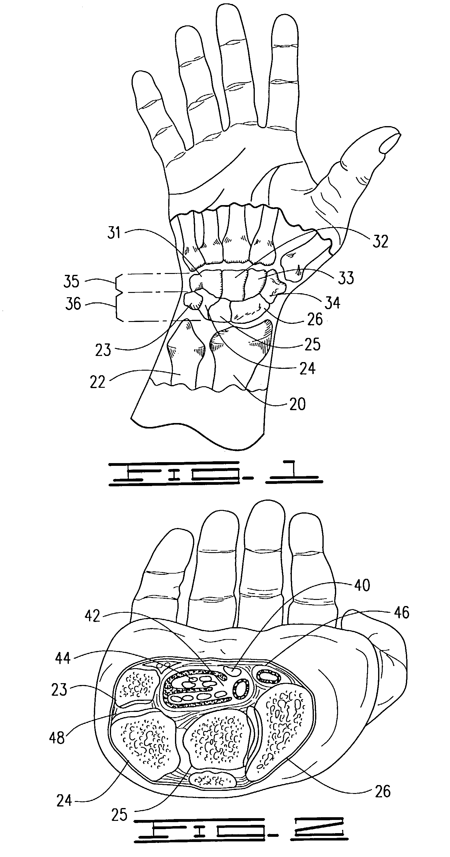 Co-dynamic adjustable orthotic appliance for carpal tunnel syndrome
