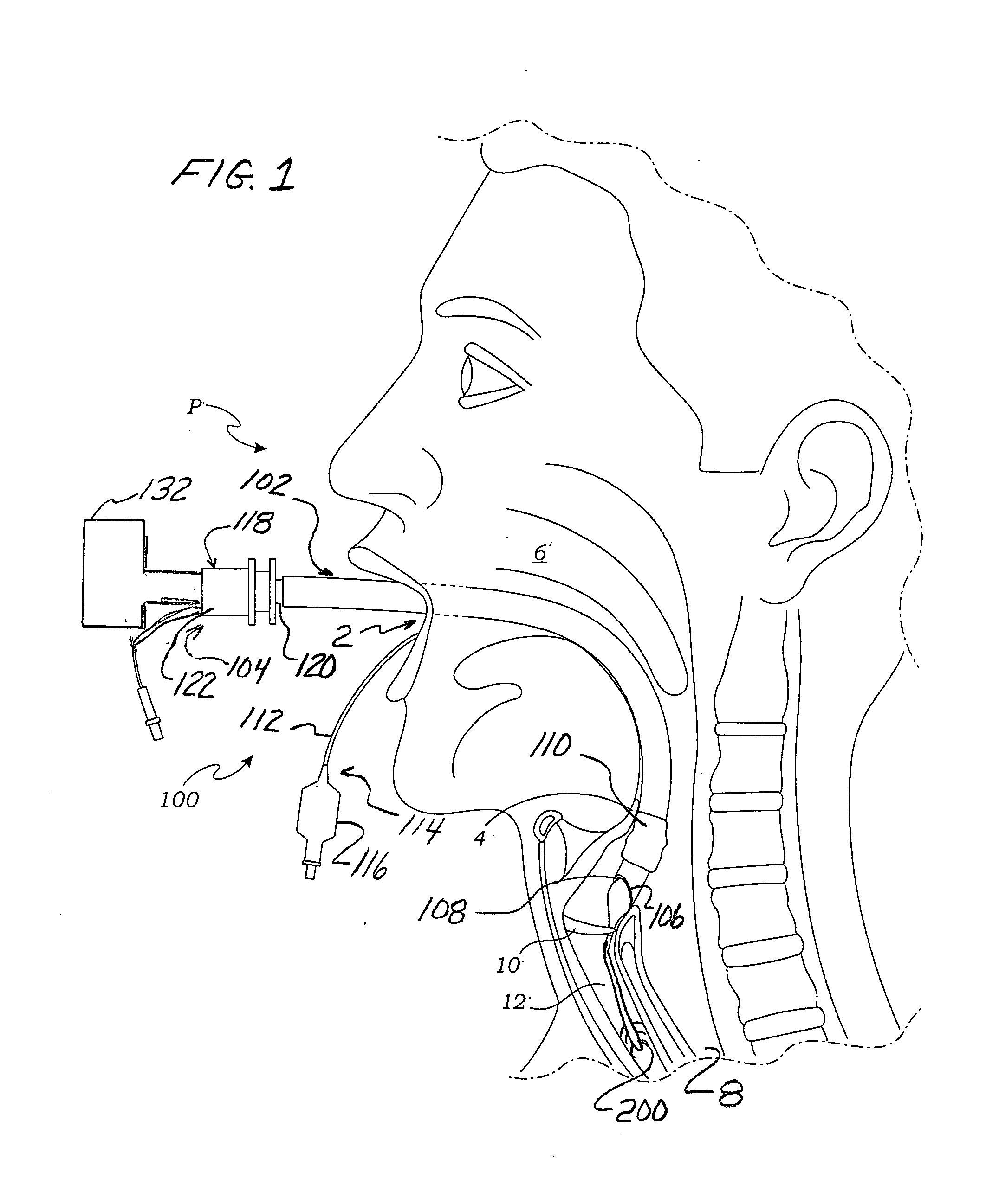 Method and device for placing an endotracheal tube