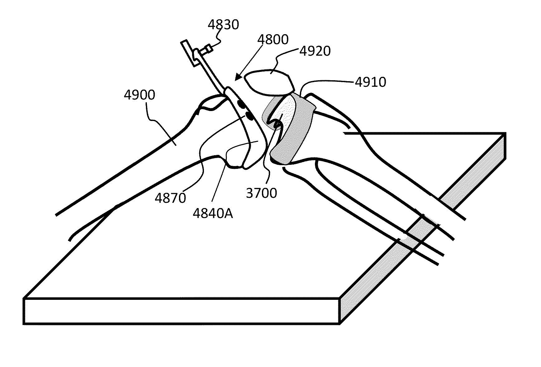 Bone cutting method for alignment relative to a mechanical axis
