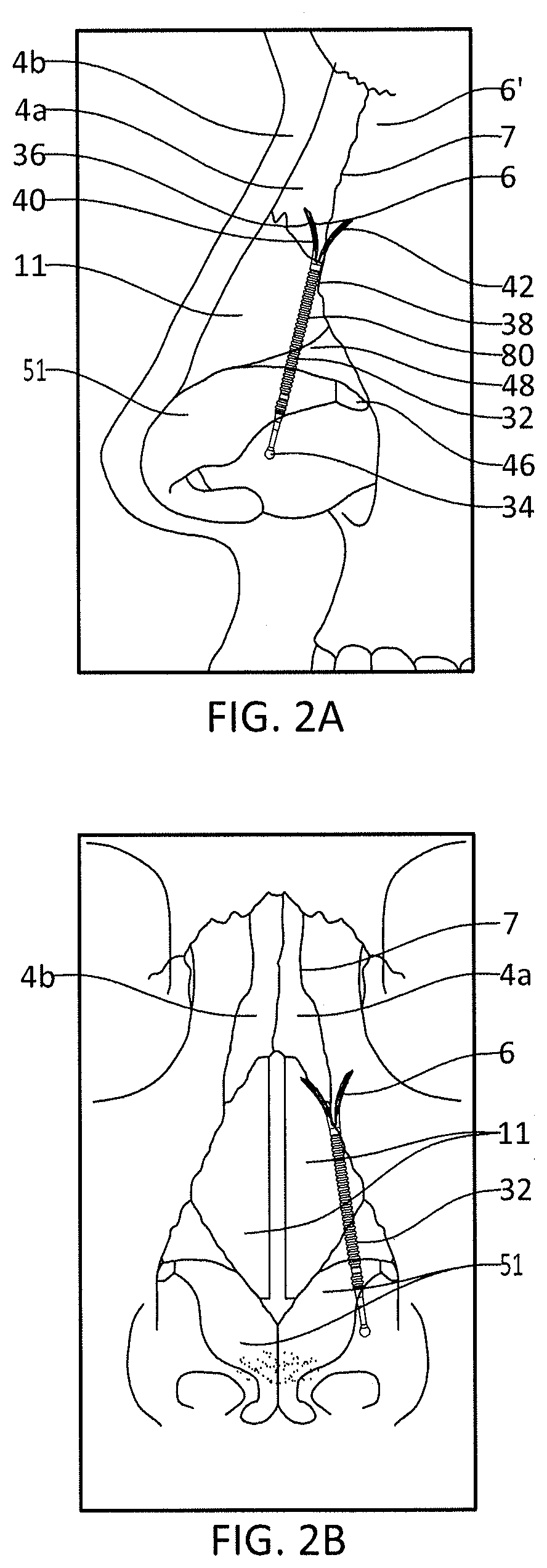 Nasal Implants and Methods of Use