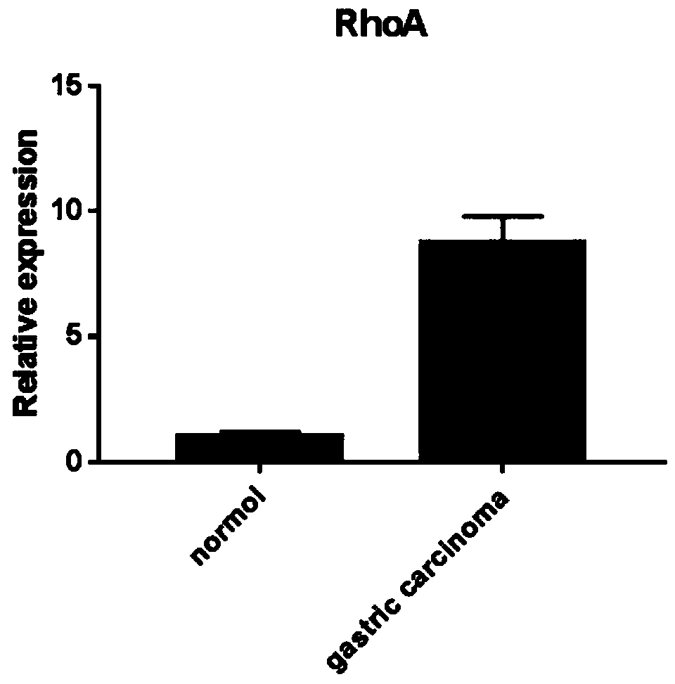 Gastric carcinoma diagnosis kit combining RhoA signal path monitoring with microRNAs (micro Ribonucleic Acids) and application thereof