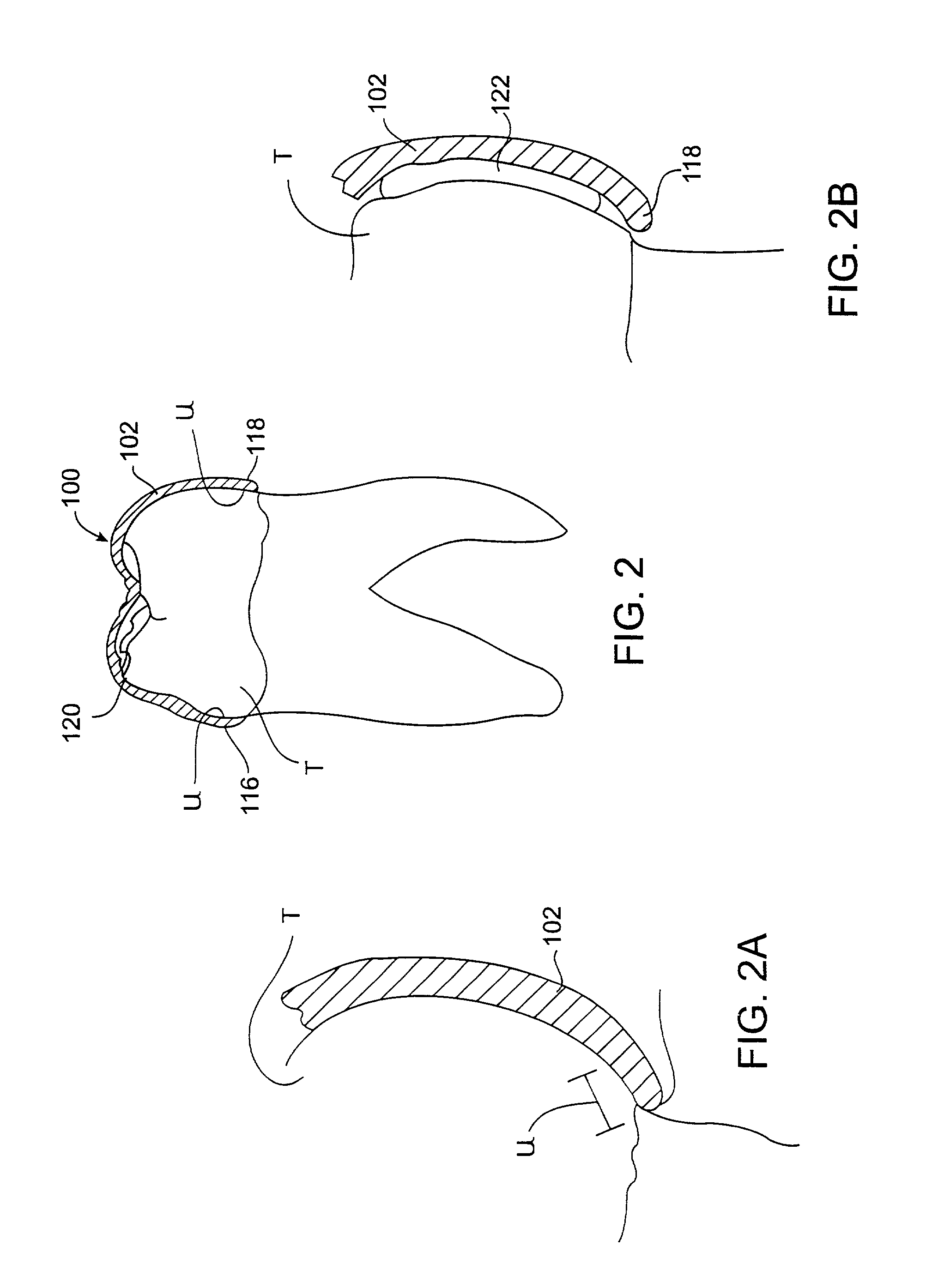 System and method for releasing tooth positioning appliances