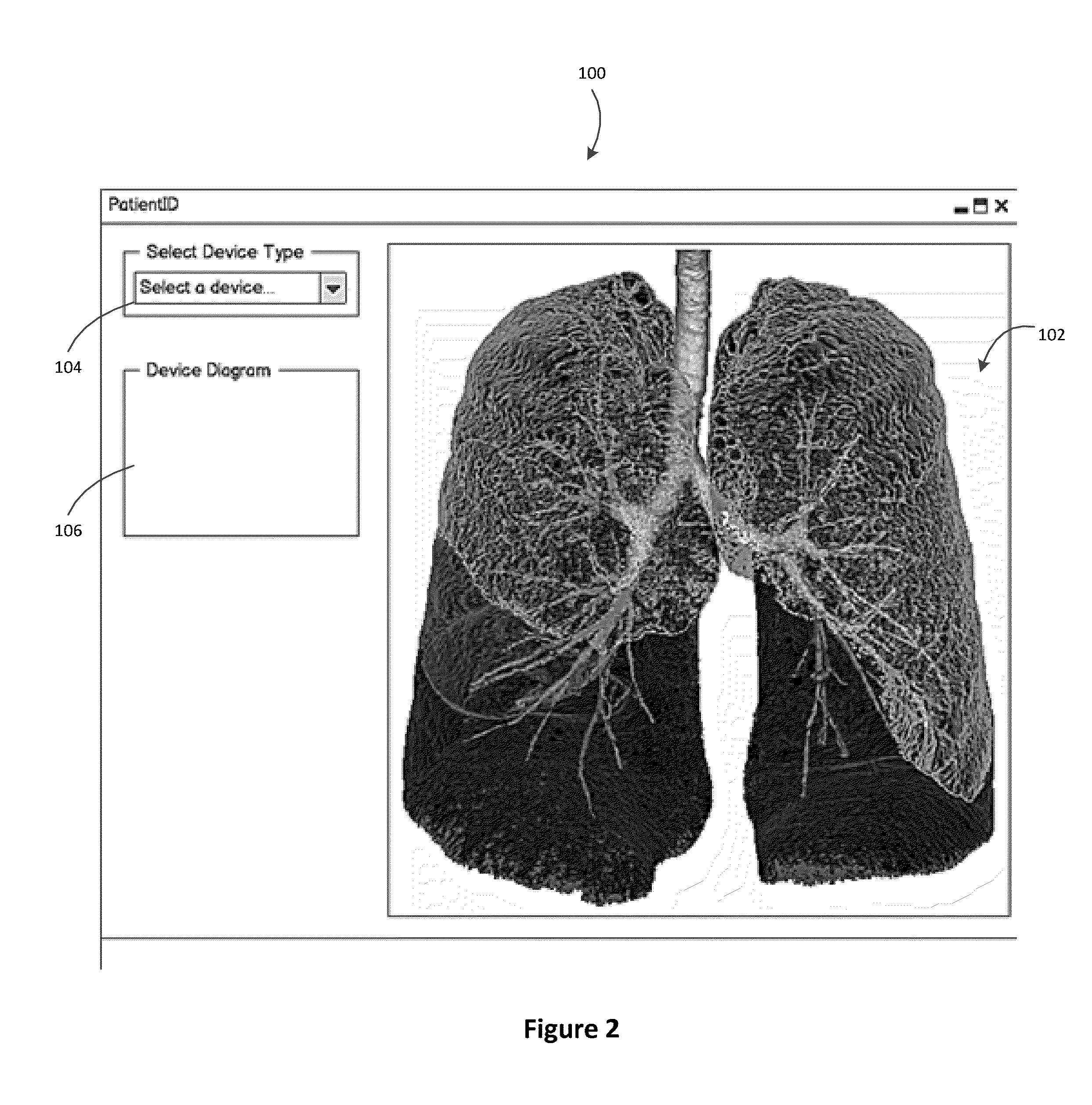 Treatment planning for lung volume reduction procedures