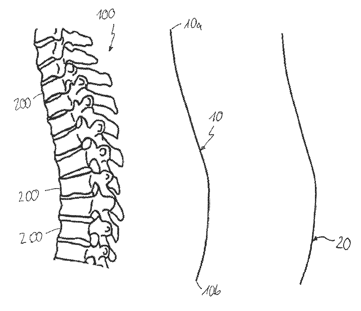 Method of using template in manufacturing an implant for spinal or other orthopedic fixation