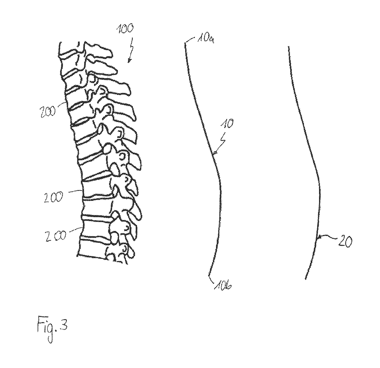 Method of using template in manufacturing an implant for spinal or other orthopedic fixation