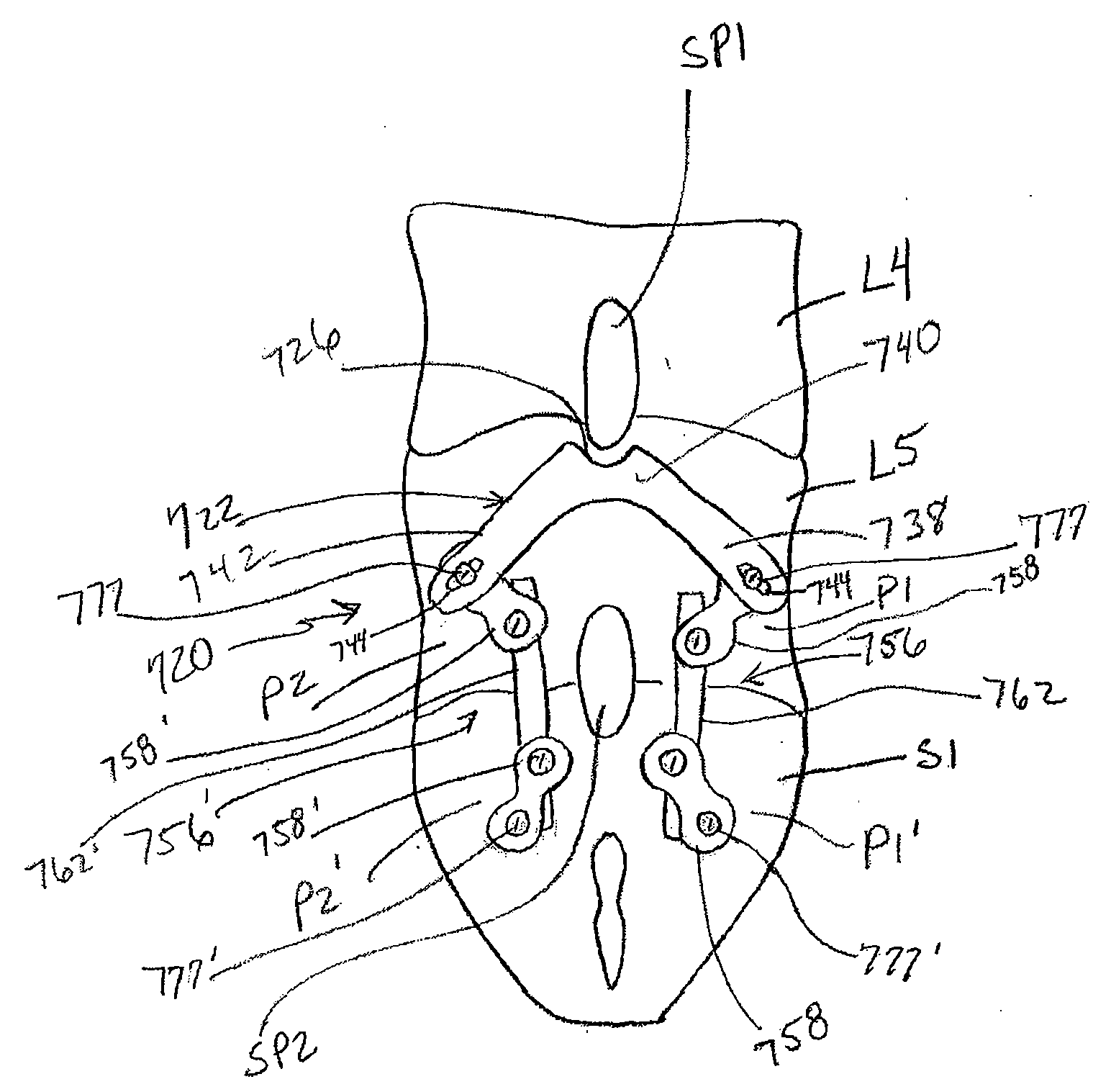 Spinous-process implants and methods of using the same