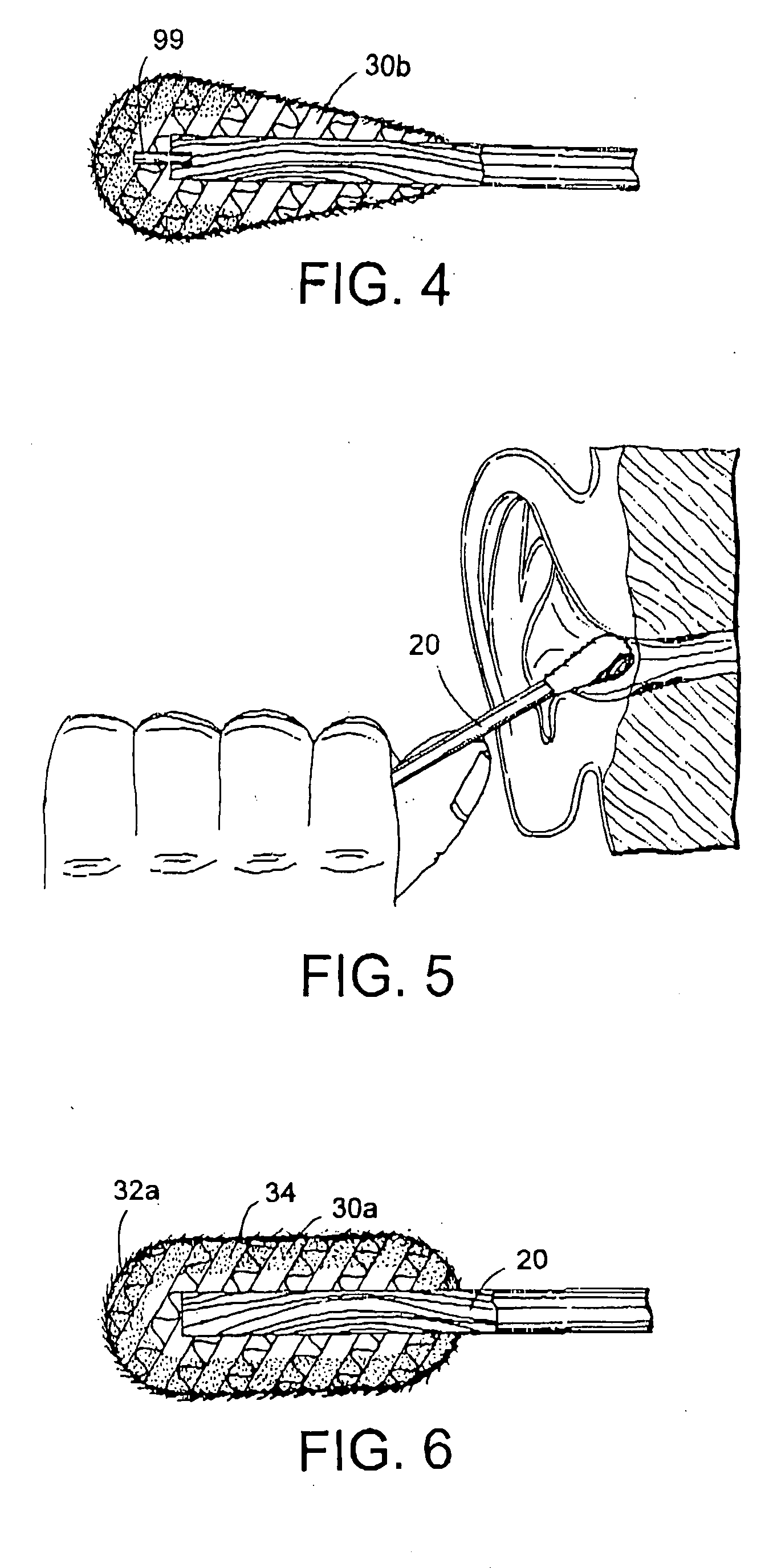 Method and apparatus for removal of cerumen