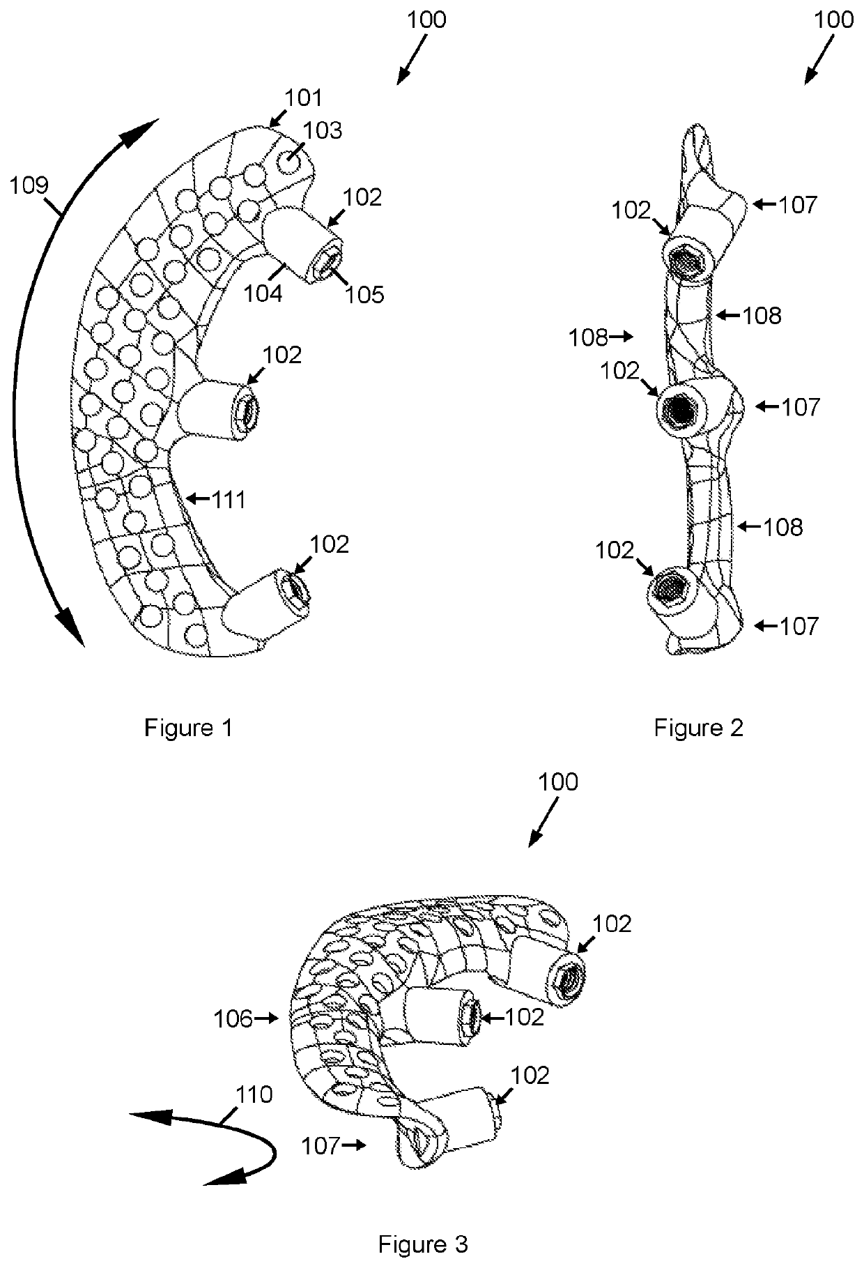 Procedure and orbital implant for orbit anchored bone affixation of an eye prosthesis