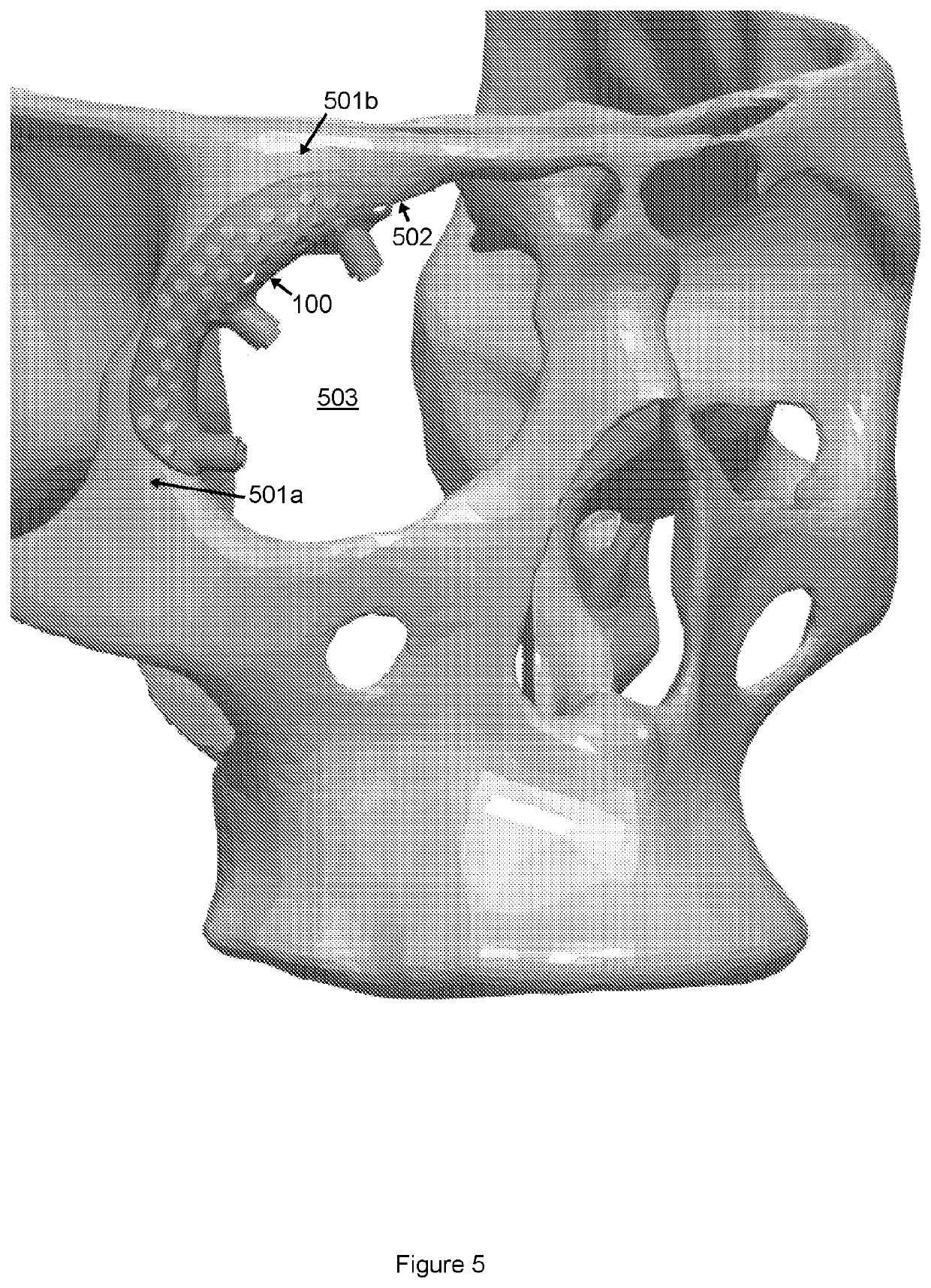 Procedure and orbital implant for orbit anchored bone affixation of an eye prosthesis