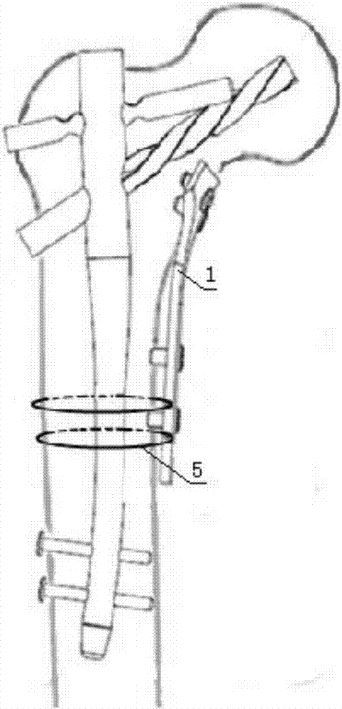 Fixation device for medial wall of femoral intertrochanteric fracture