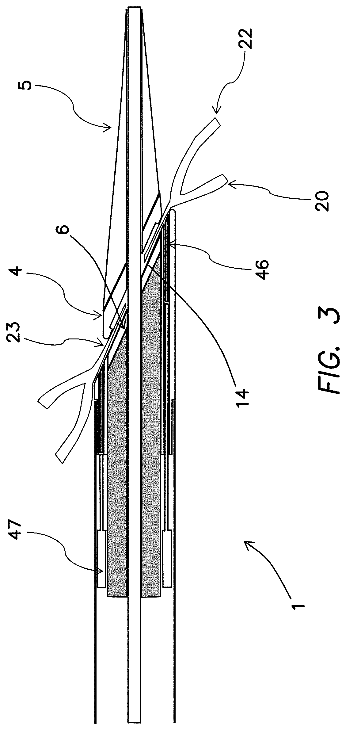 Percutaneous arterial to venous anastomosis clip application catheter system and methods