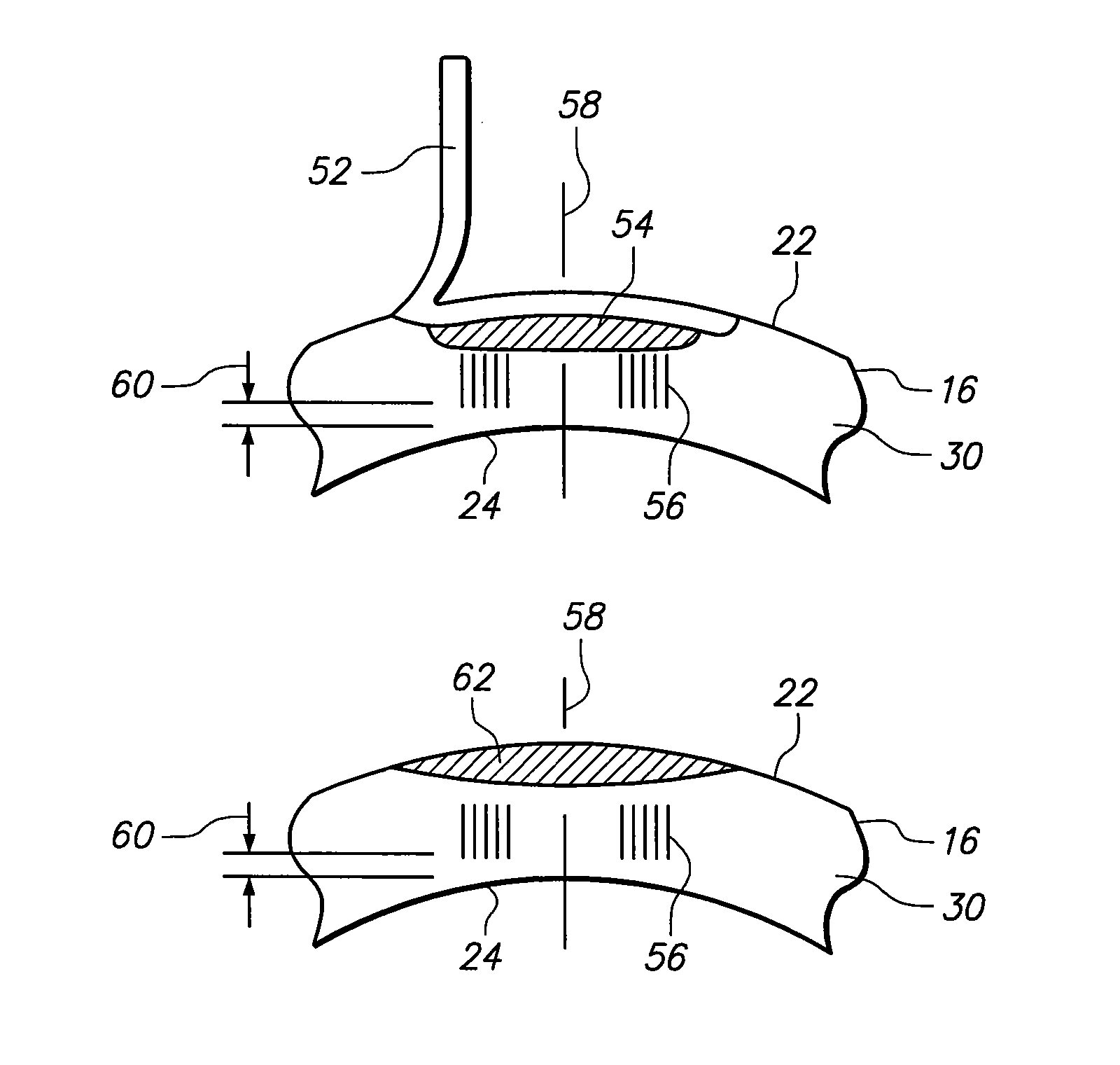 System and method for refractive surgery with augmentation by intrastromal corrective procedure