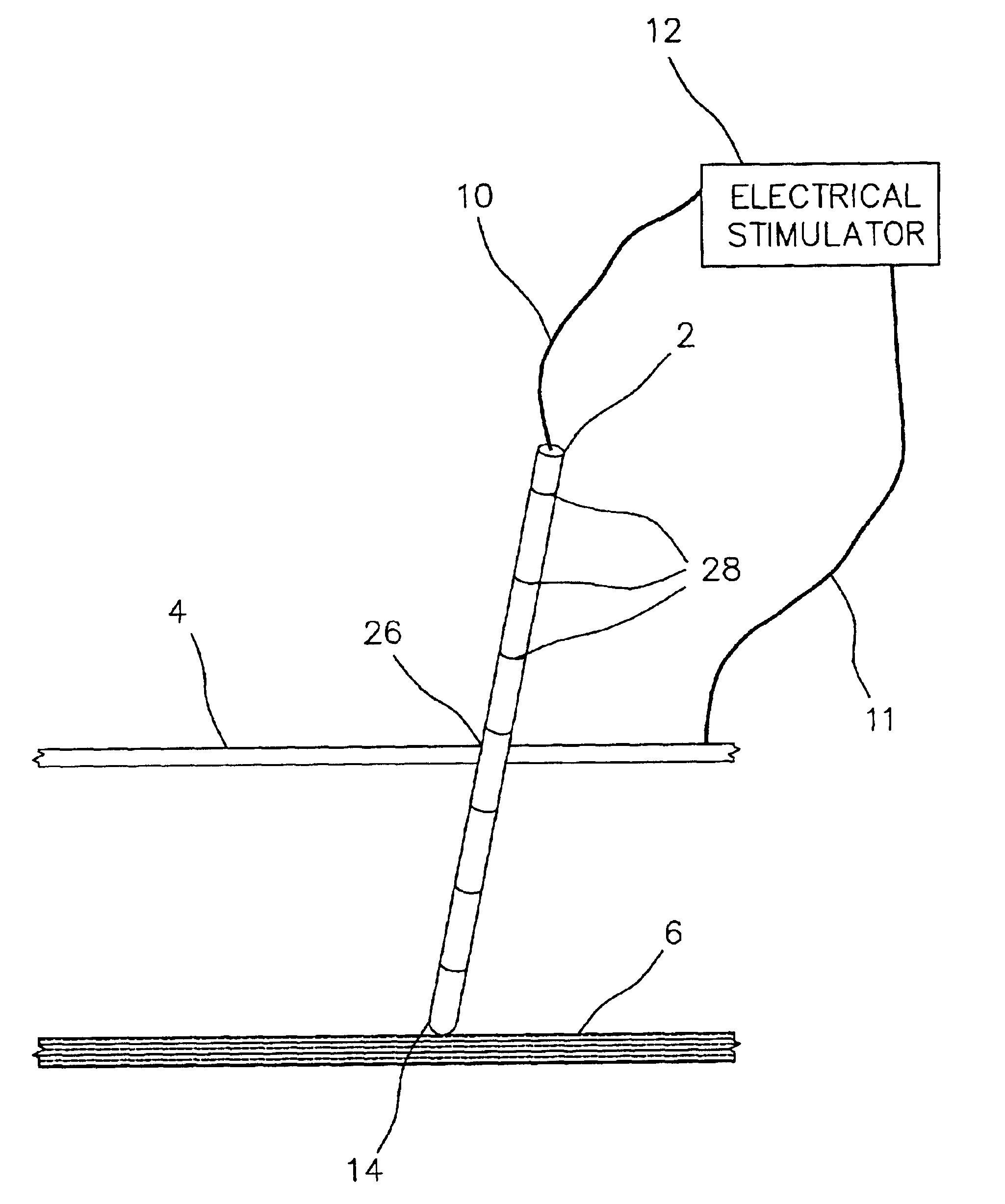 Electrically sensing and stimulating system for placement of a nerve stimulator or sensor