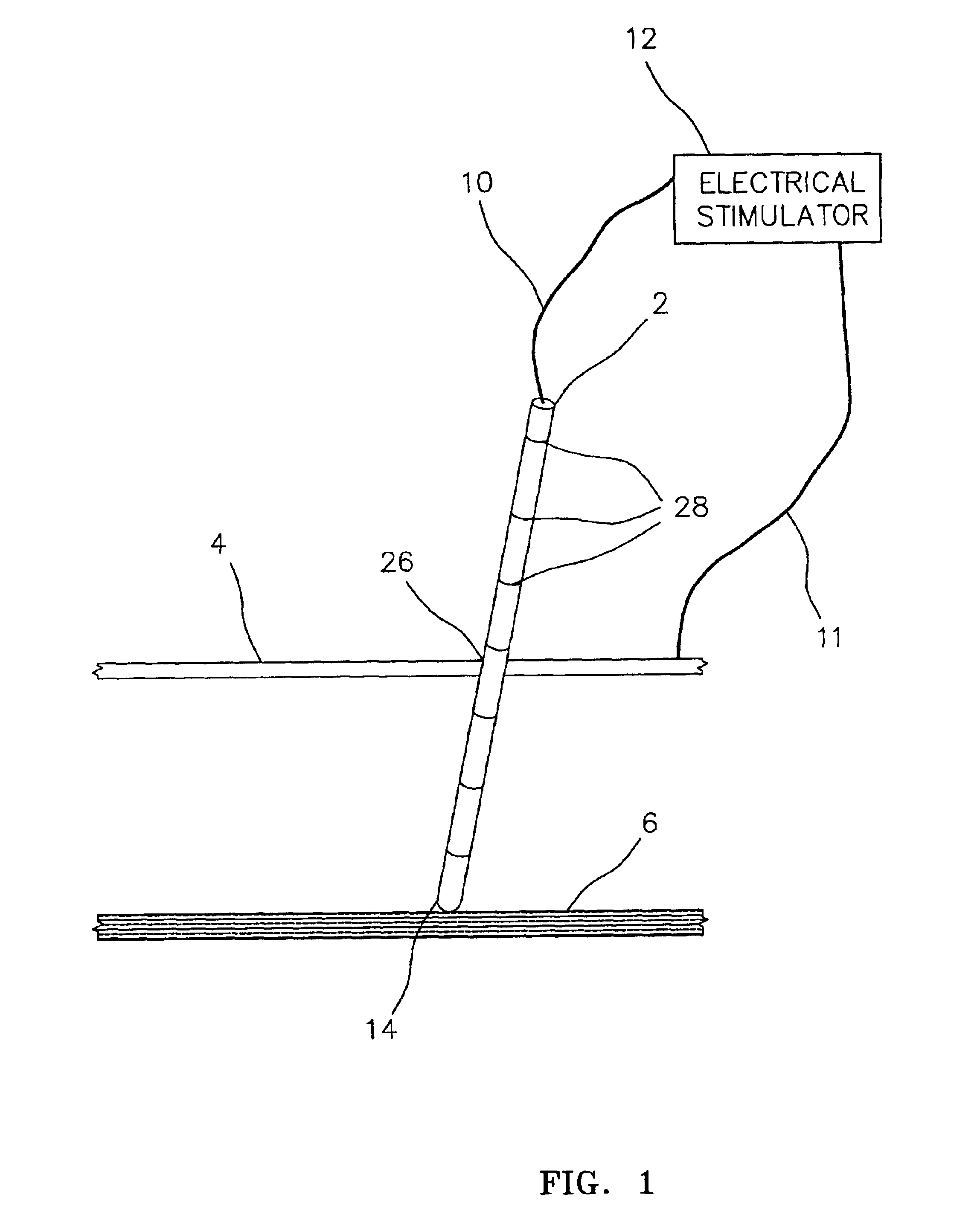 Electrically sensing and stimulating system for placement of a nerve stimulator or sensor