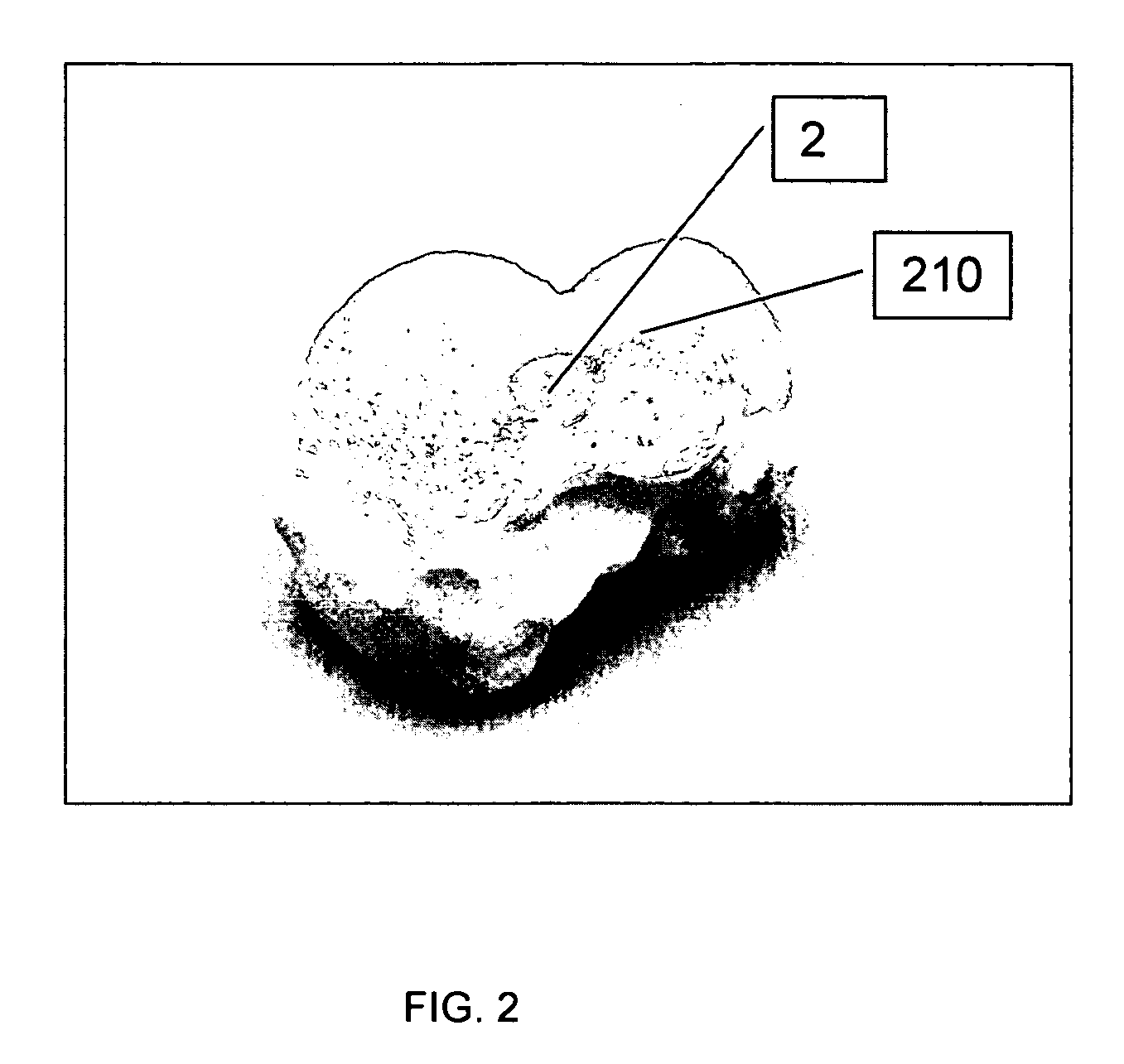 Implants and delivery system for treating defects in articulating surfaces