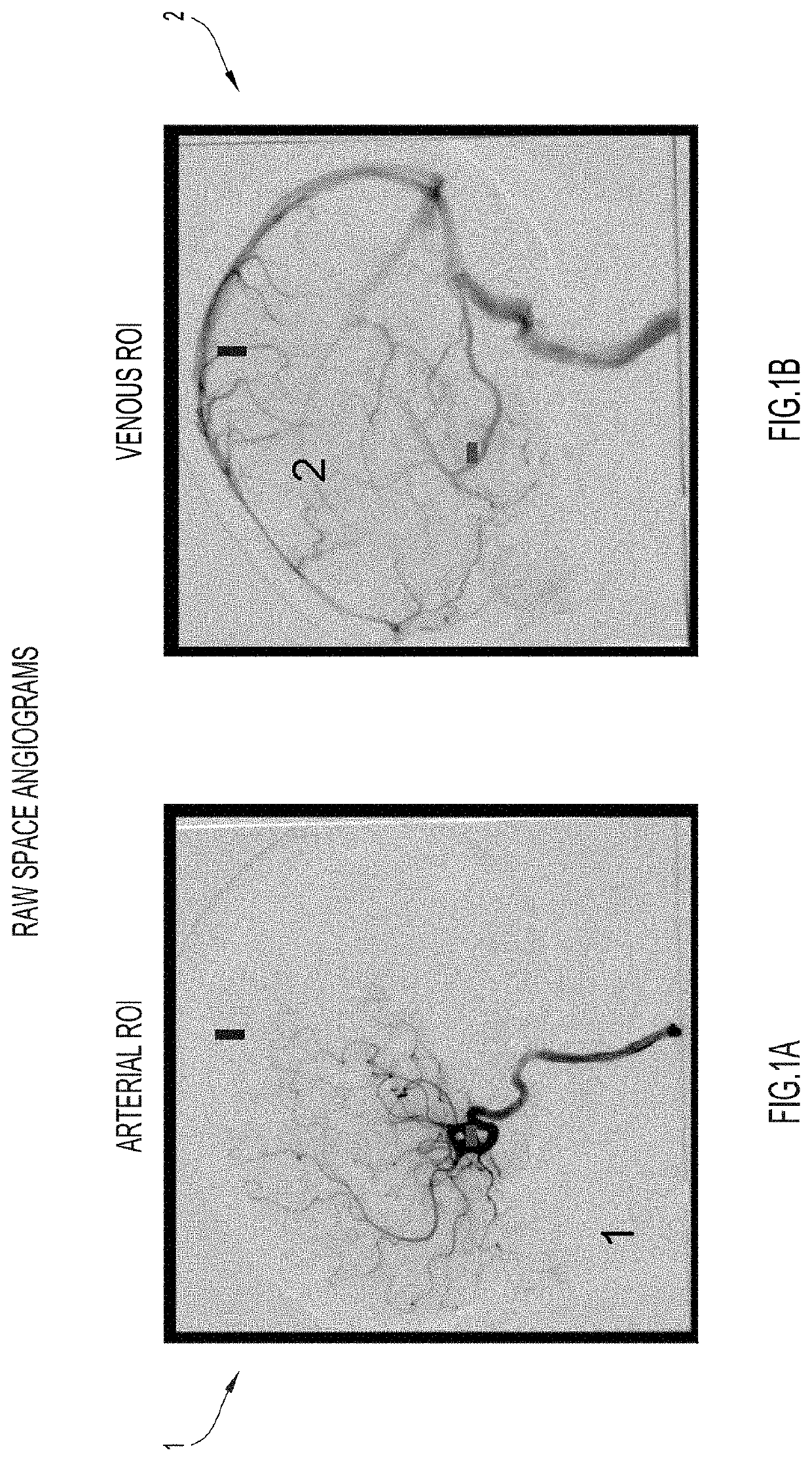 Spatiotemporal reconstruction in higher dimensions of a moving vascular pulse wave from a plurality of lower dimensional angiographic projections
