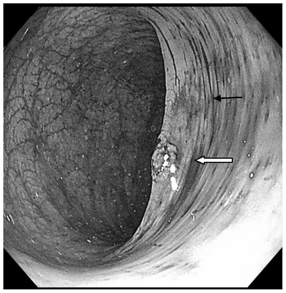 Application of Red Cabbage Pigment in Preparation of Endoscope Stain