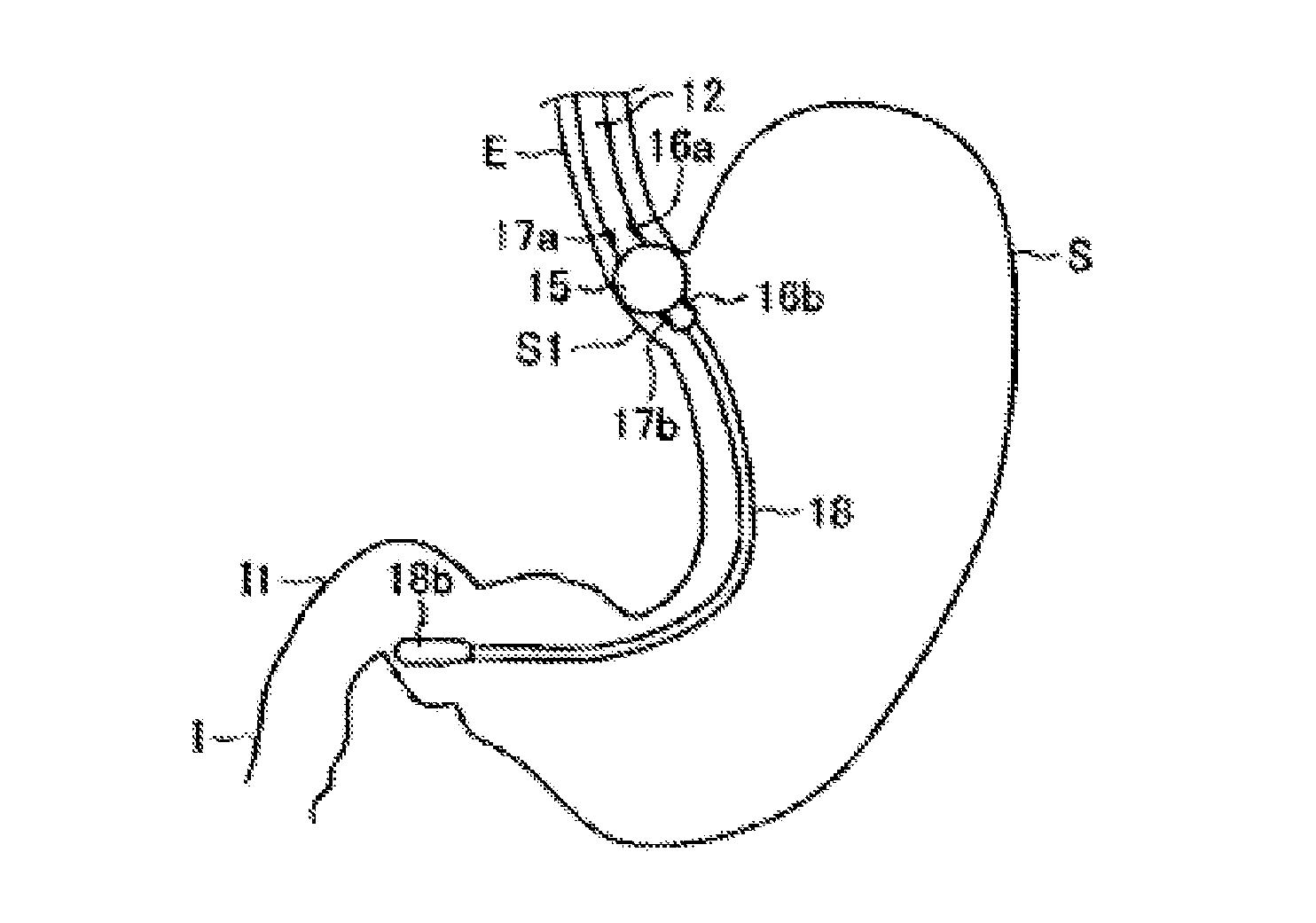 Tube for Gastrointestinal Tract