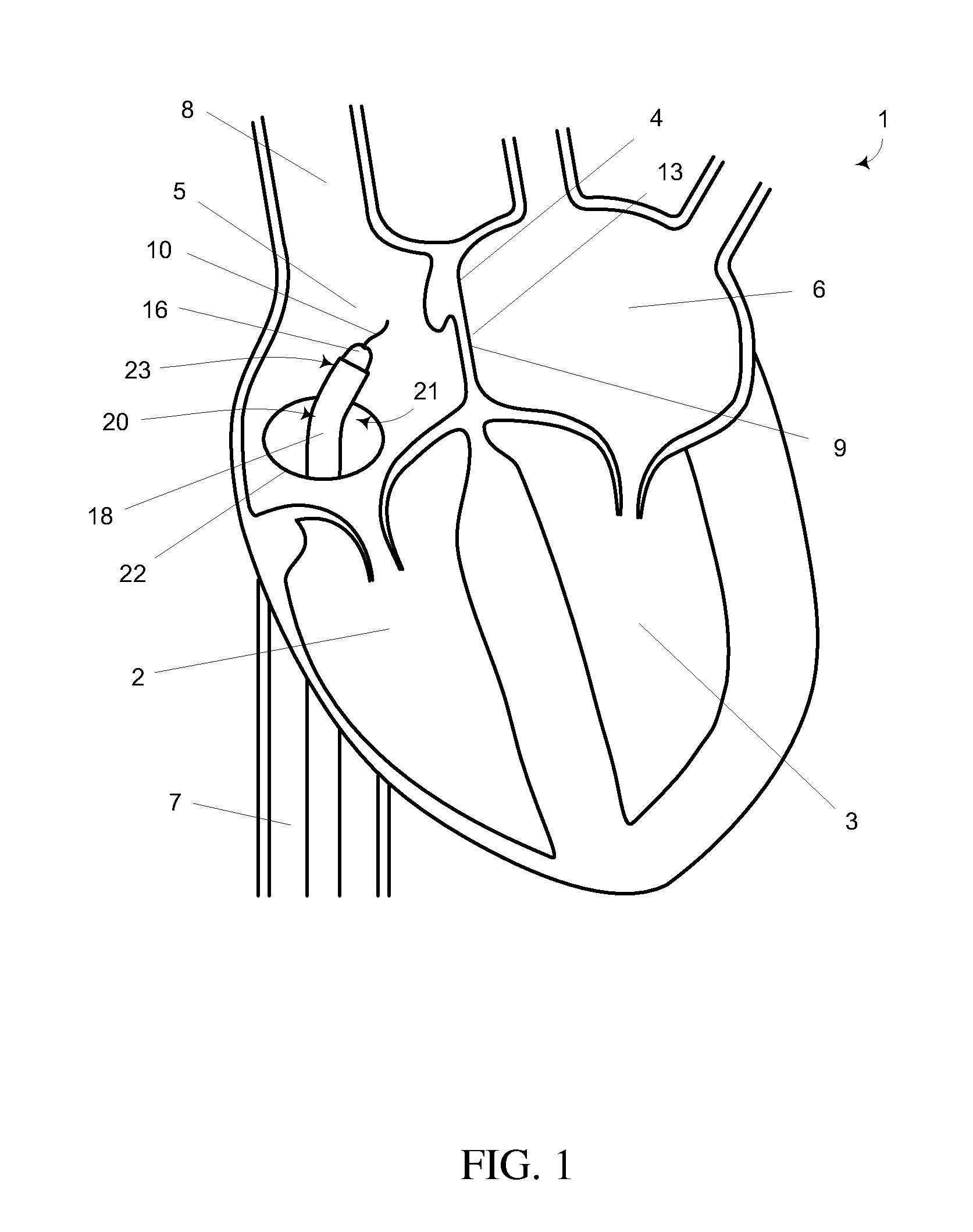Mitral valve spacer and system and method for implanting the same