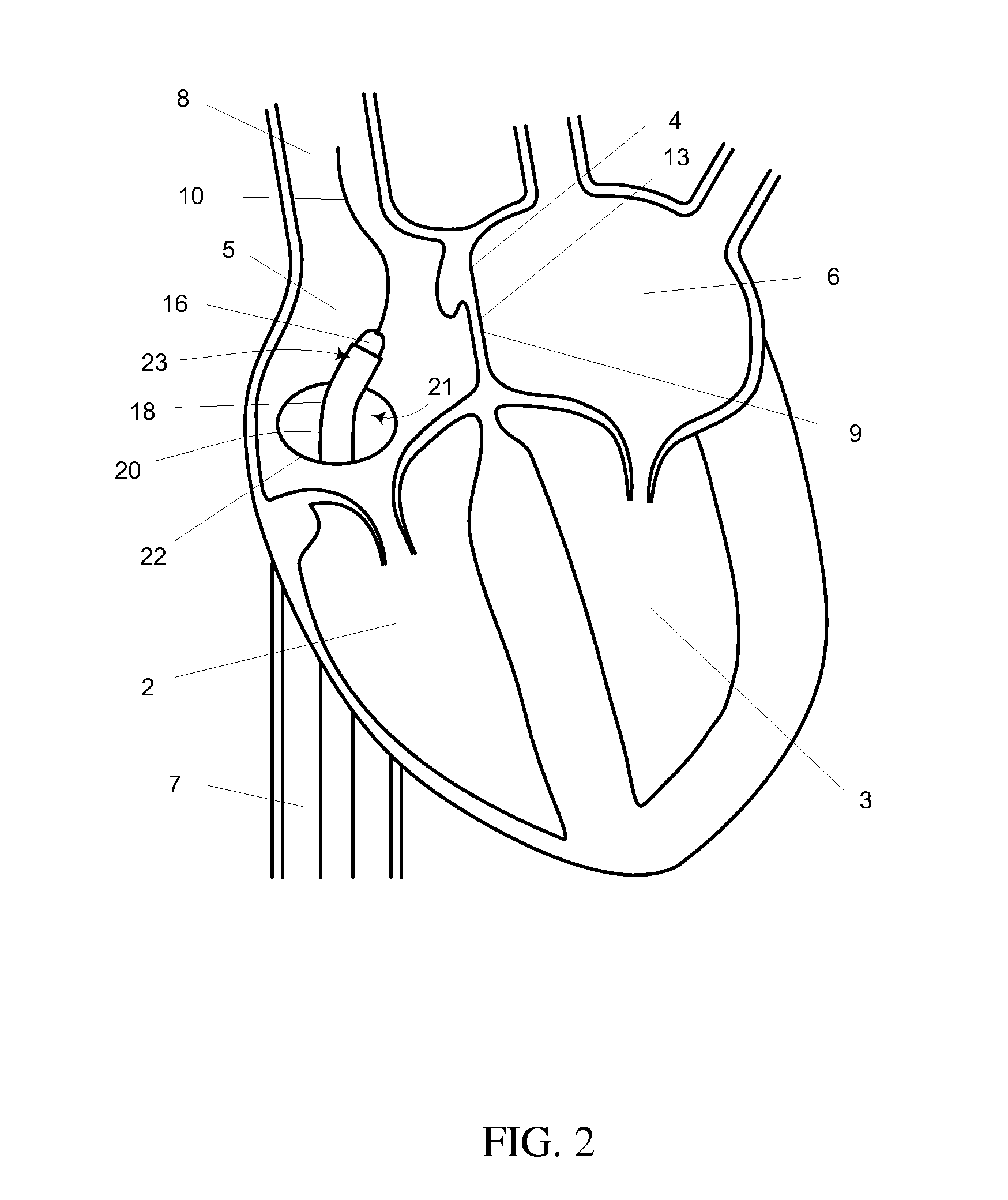 Mitral valve spacer and system and method for implanting the same