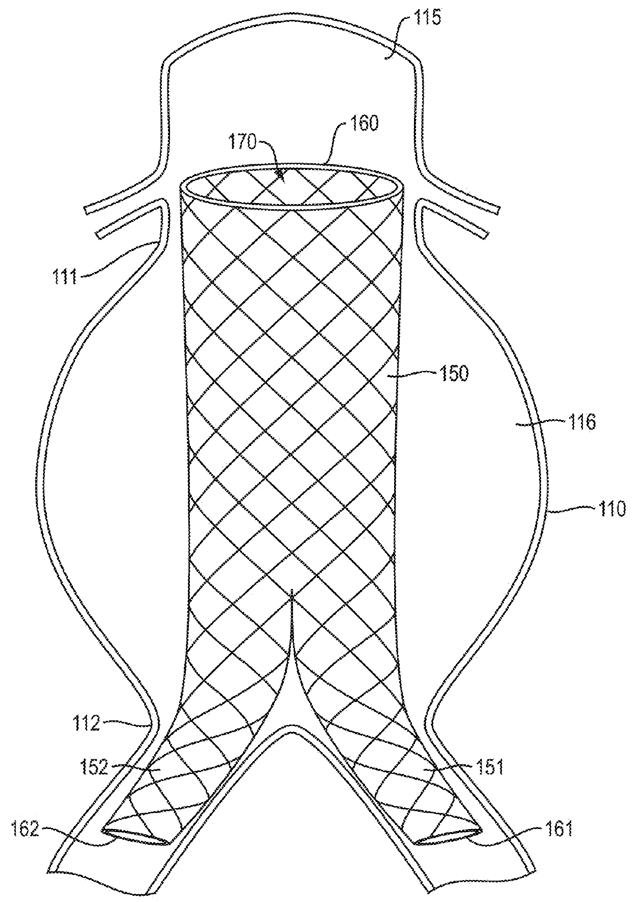 In-situ forming foams with outer layer