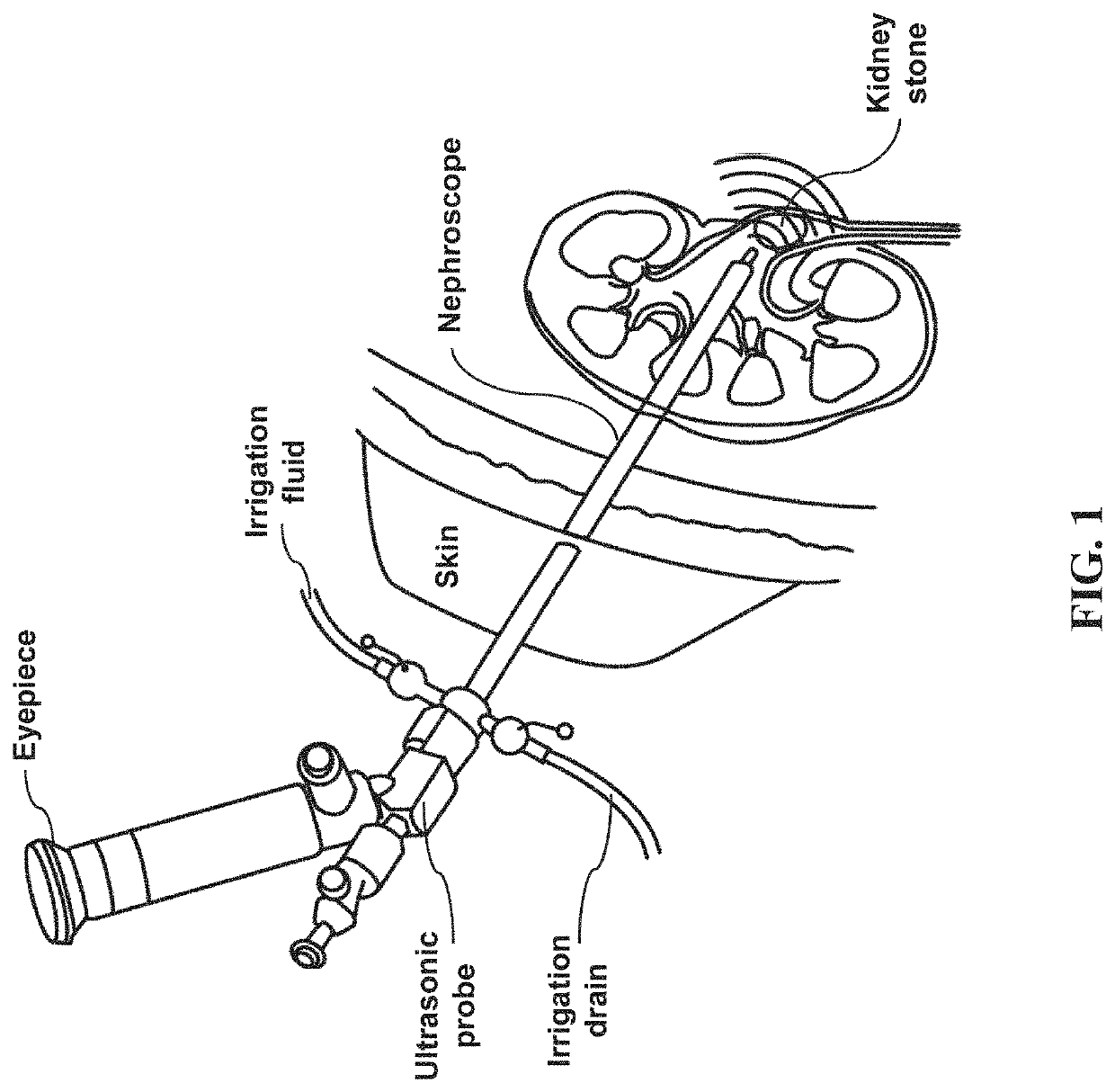 Method and system for interactive 3D scope placement and measurements for kidney stone removal procedure