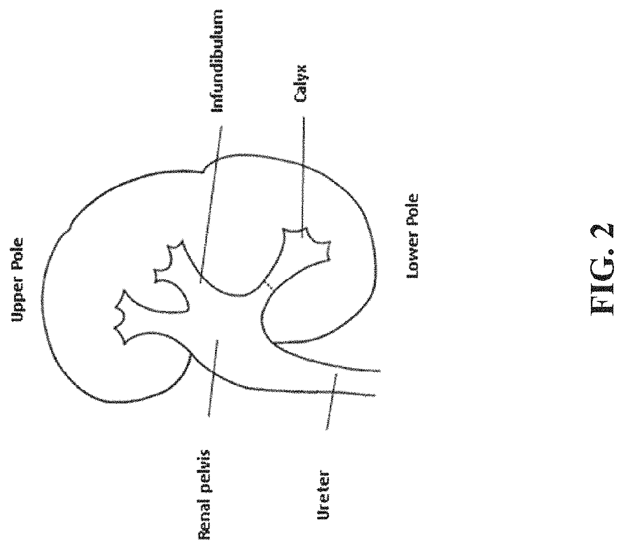 Method and system for interactive 3D scope placement and measurements for kidney stone removal procedure