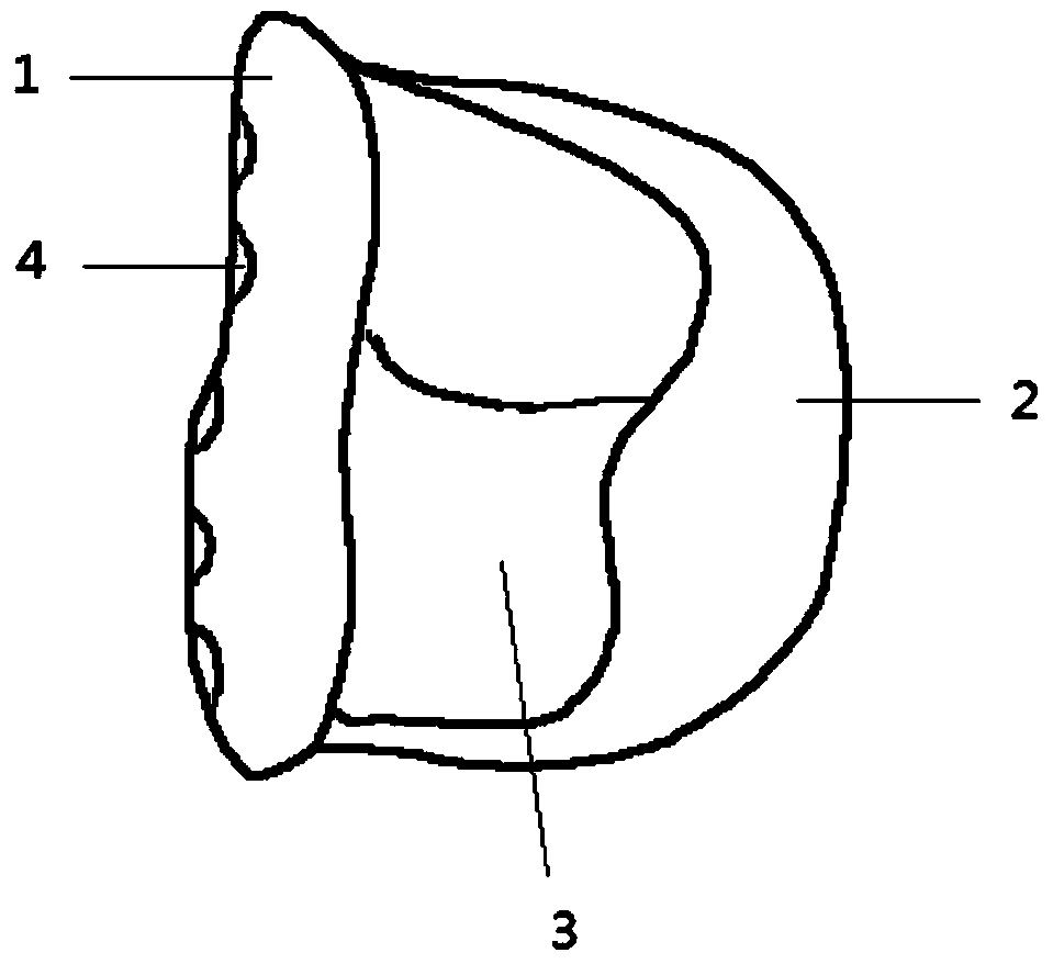 A Personalized Temporomandibular Joint Fossa Prosthesis