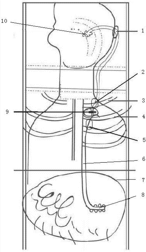 Inferior regulation ventriculo-peritoneal shunt pipe