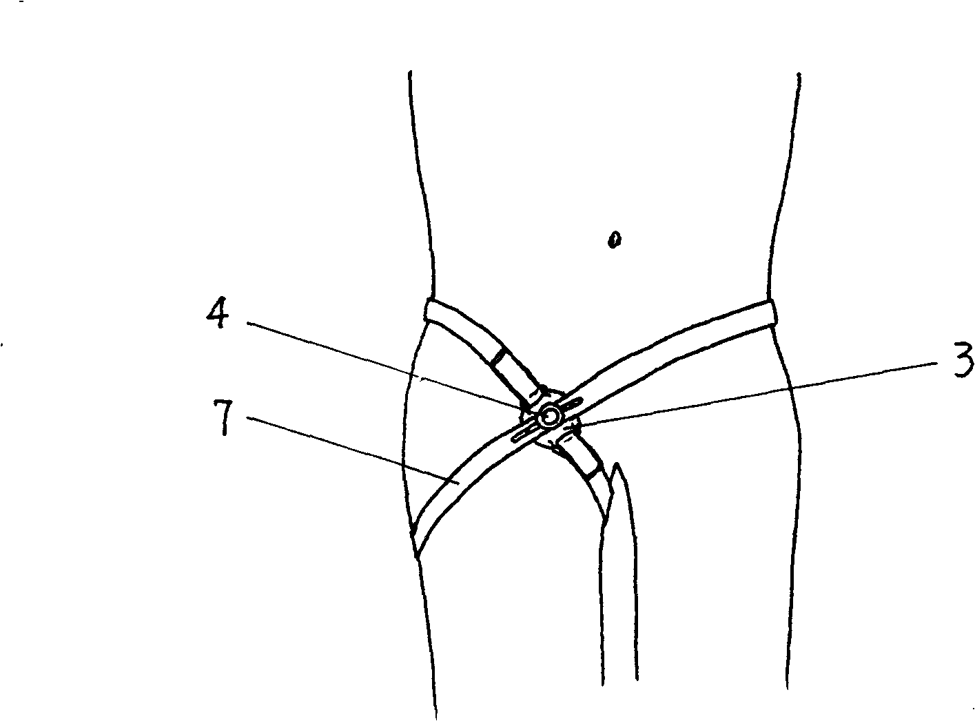 Disposable arteria femoralis compression hemostat