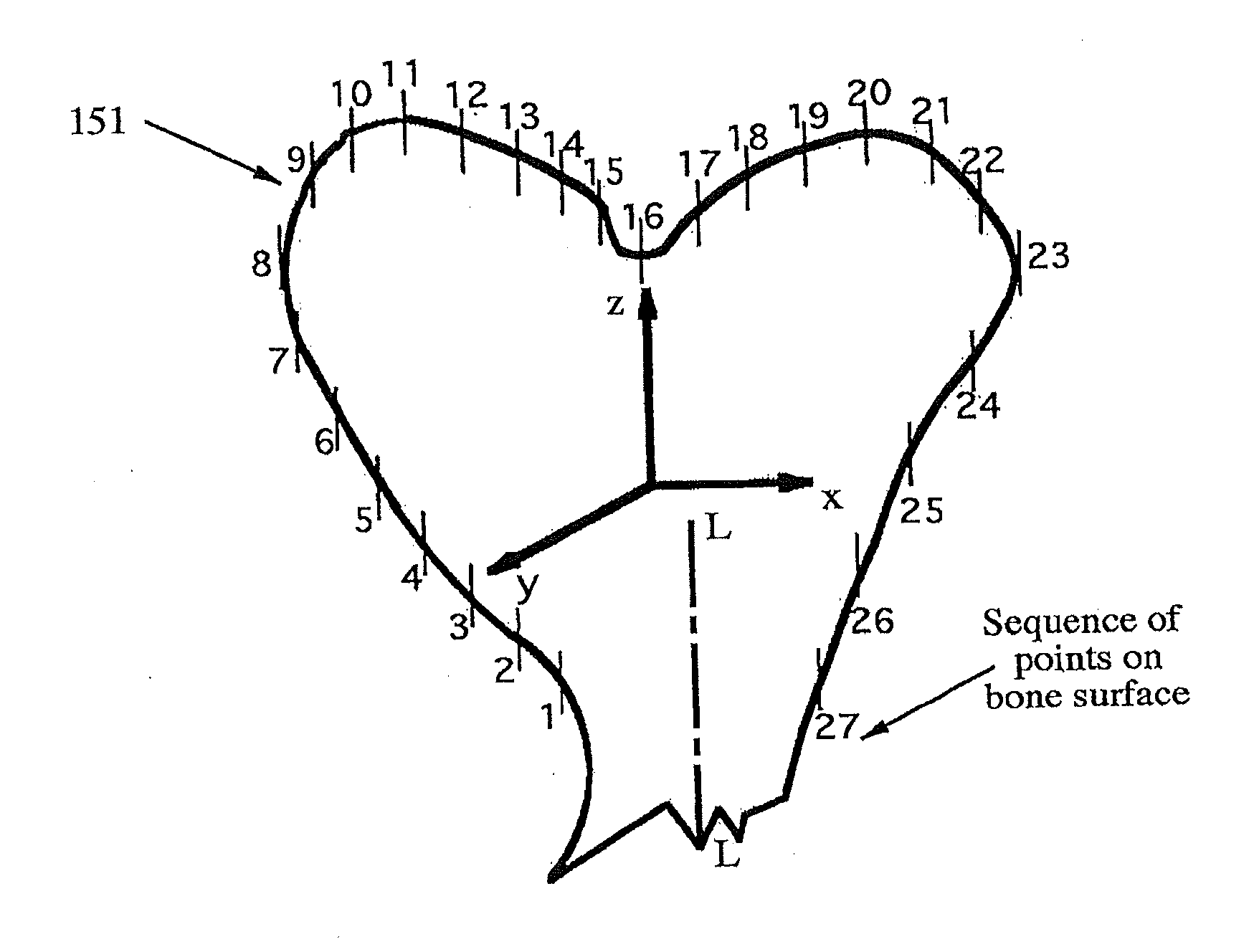 Total joint arthroplasty system