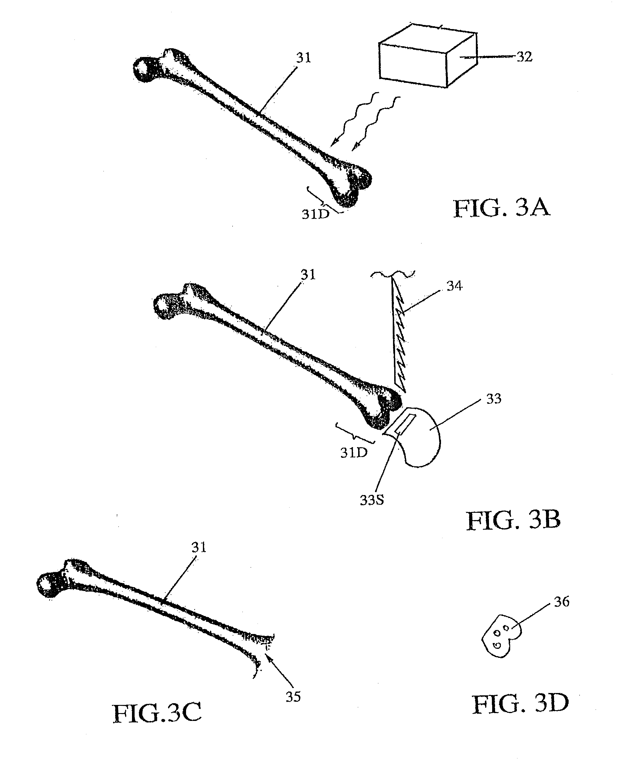 Total joint arthroplasty system