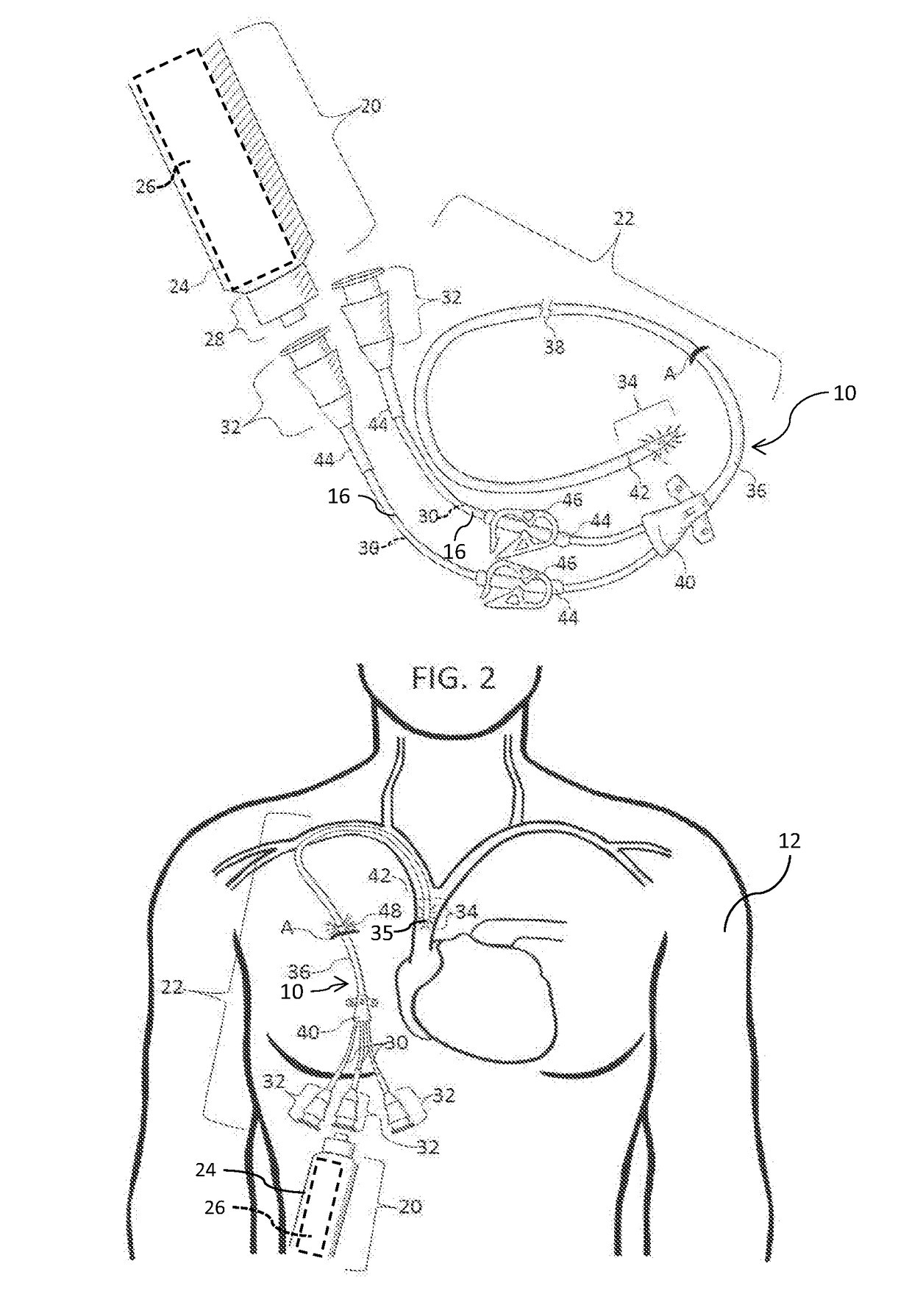 Methods and apparatus to deliver therapeutic, non-ultraviolet electromagnetic radiation to inactivate infectious agents and/or to enhance healthy cell growth via a catheter residing in a body cavity