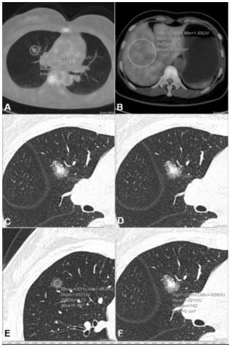 A method for identifying early lung adenocarcinoma manifested as frosted glass nodules