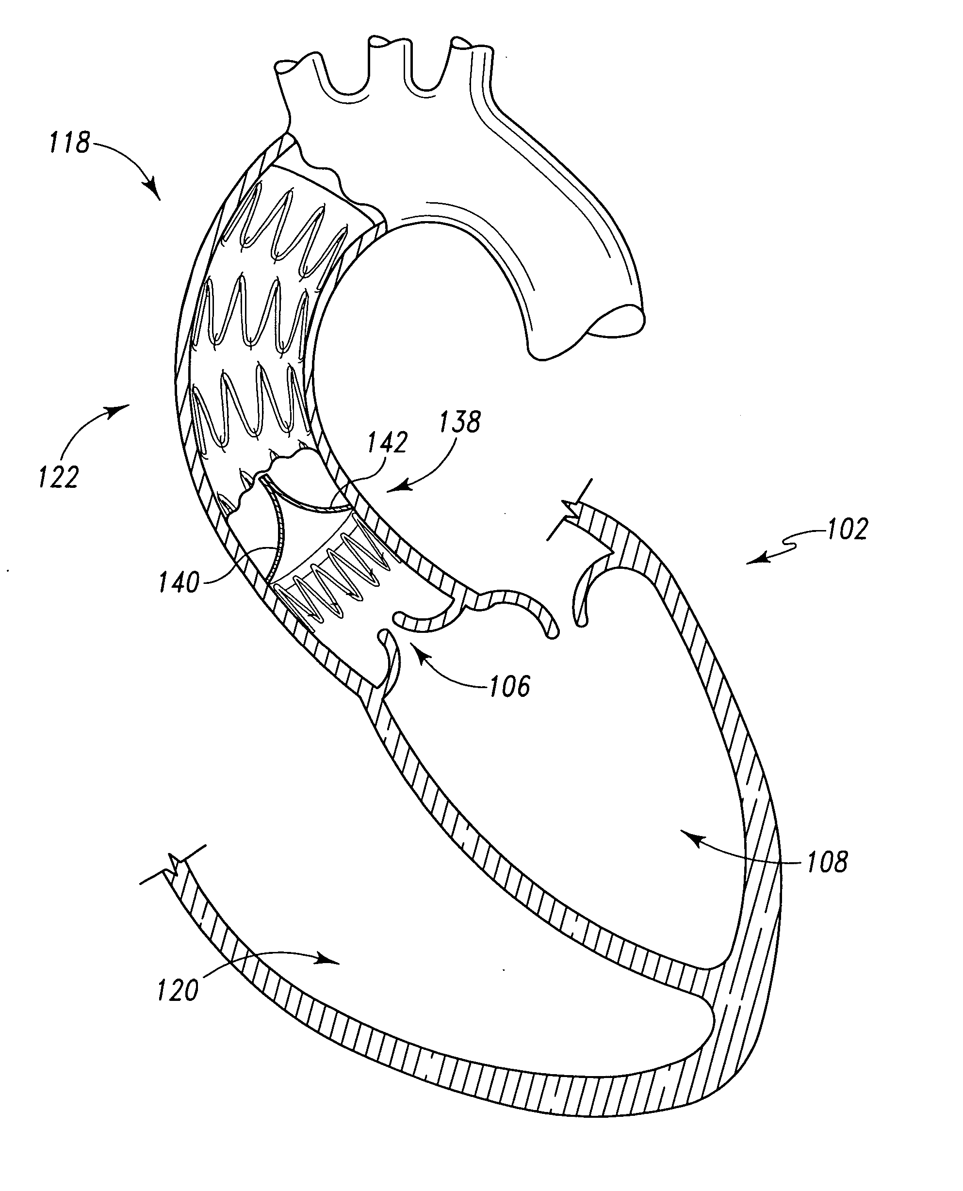 Endoluminal graft with a prosthetic valve