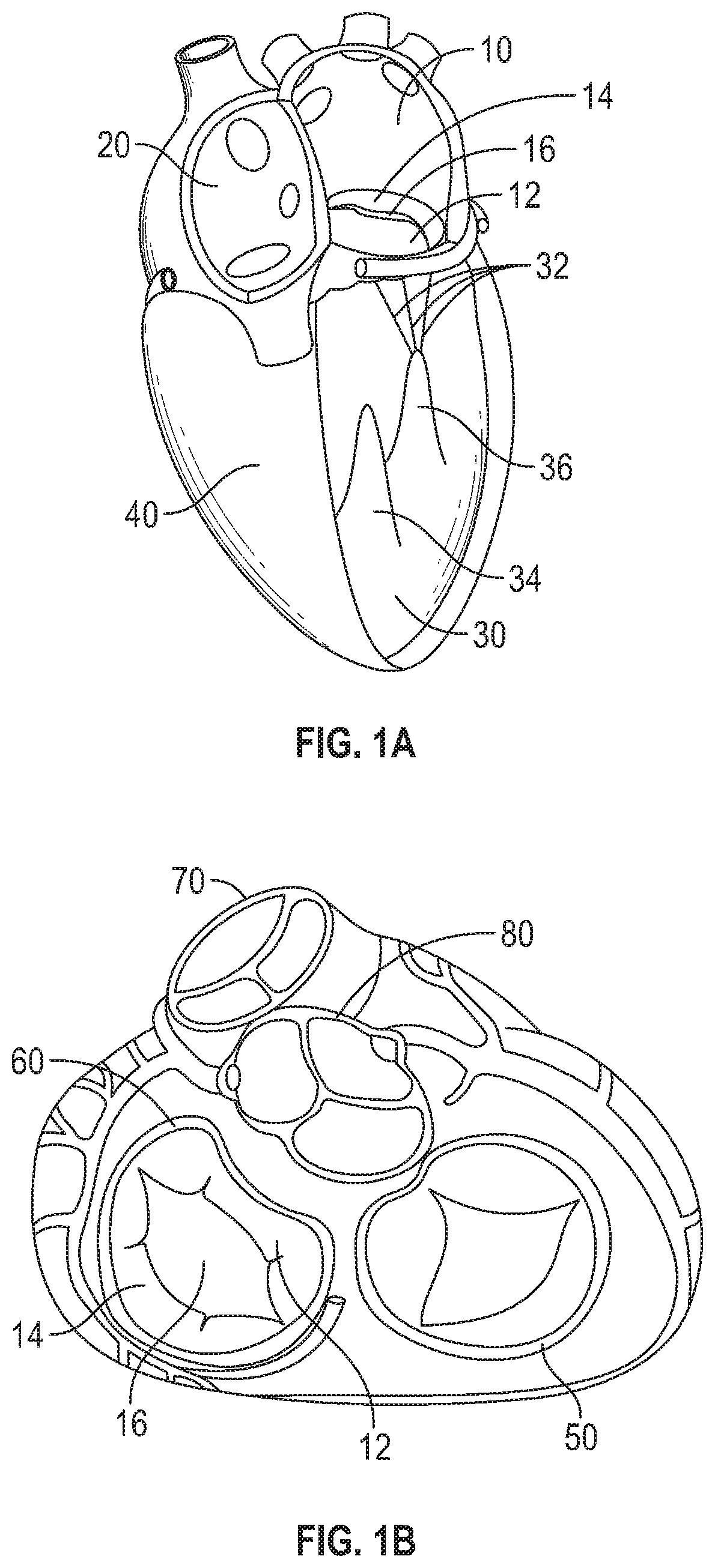 Mitral valve implants for the treatment of valvular regurgitation