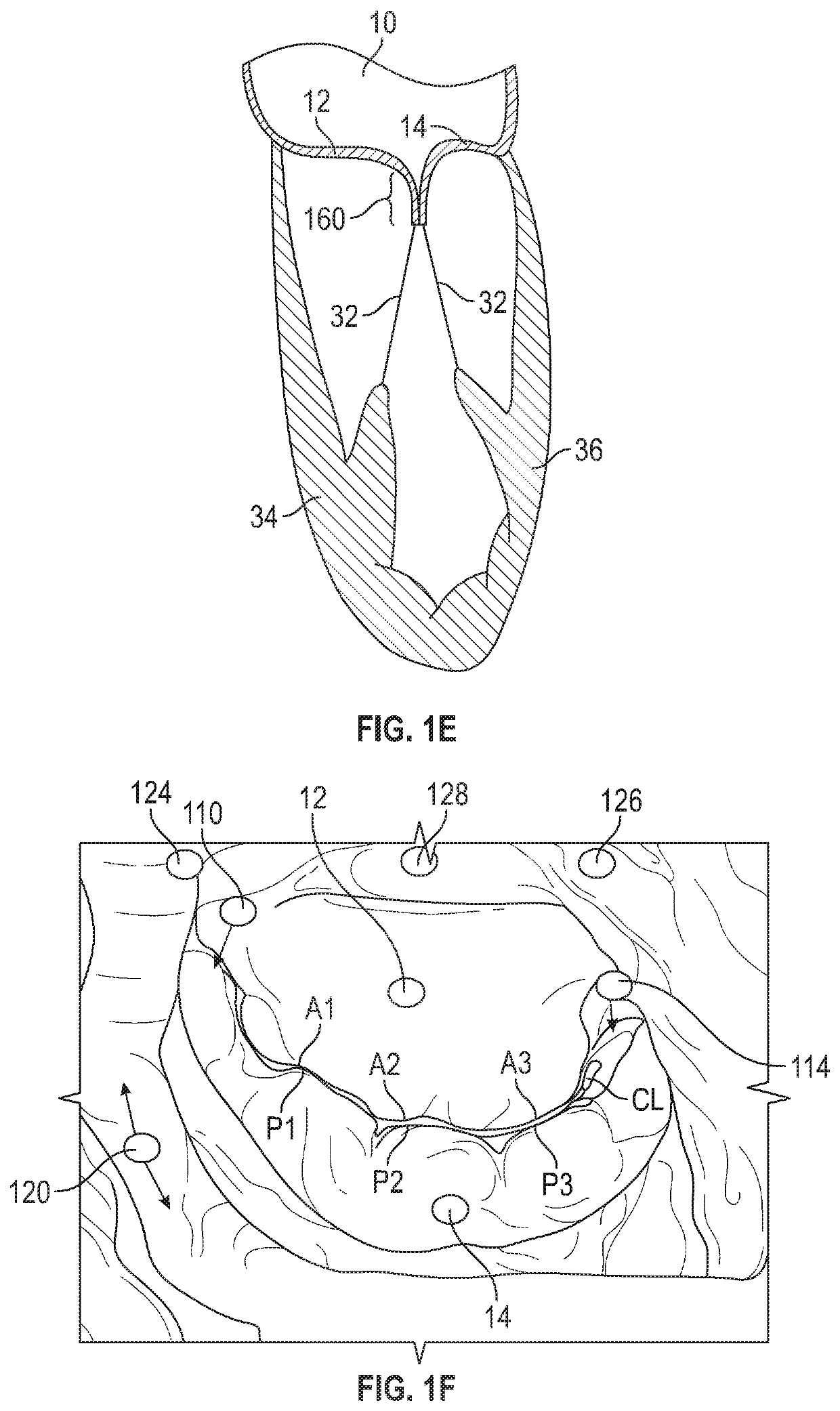 Mitral valve implants for the treatment of valvular regurgitation