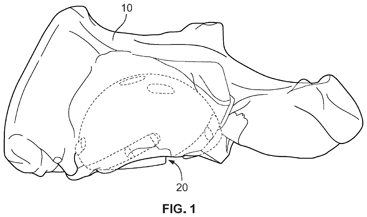 Robotic Acetabulum Preparation For Acceptance of Acetabular Cup With Engagement Features