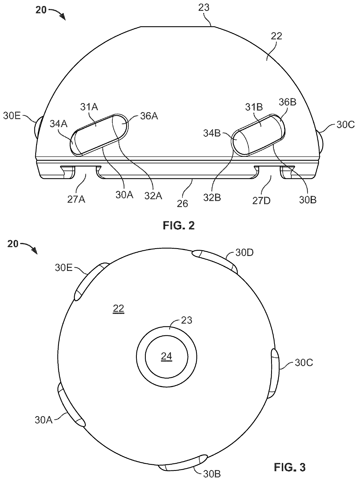 Robotic Acetabulum Preparation For Acceptance of Acetabular Cup With Engagement Features