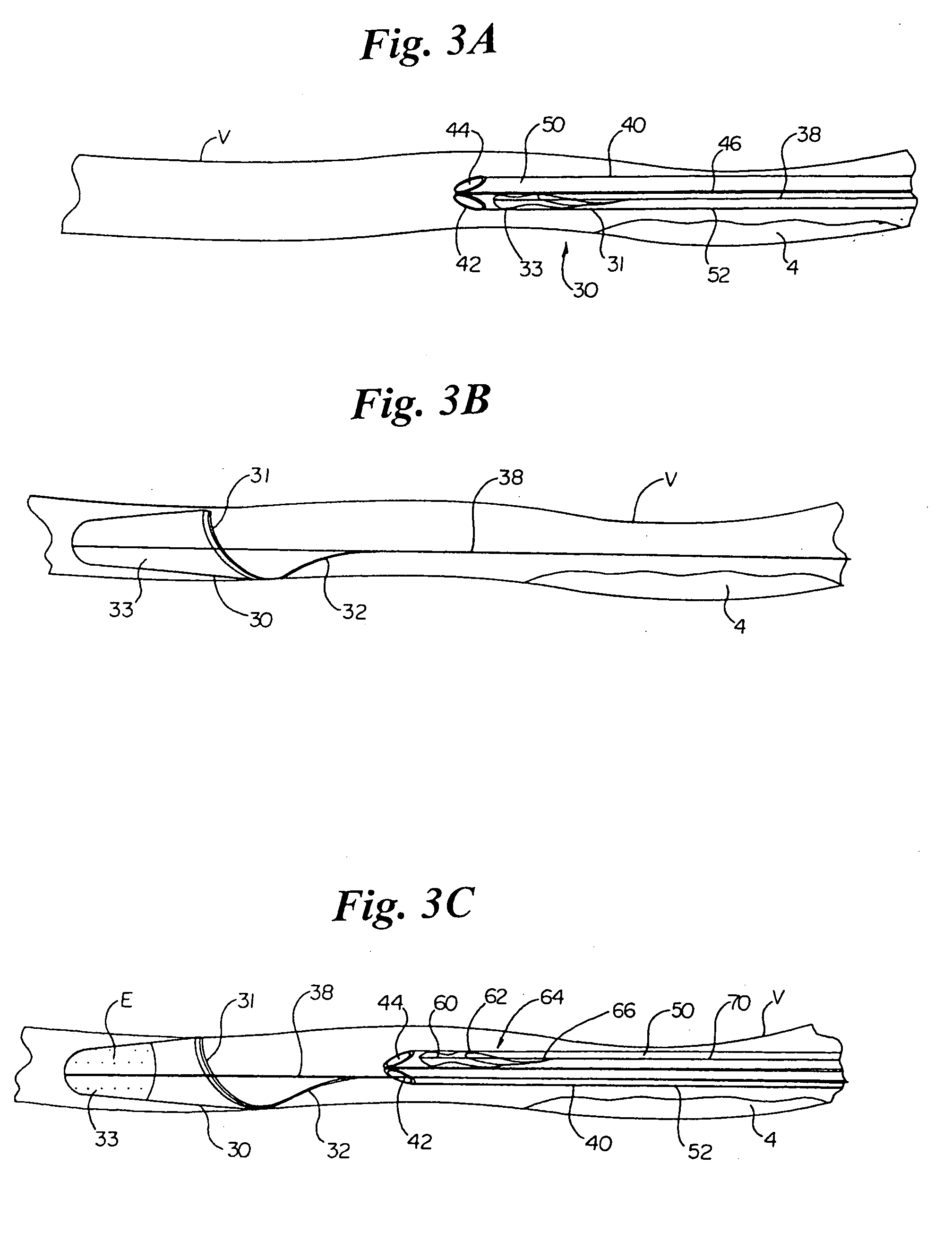 Vascular embolic filter exchange devices and methods of use thereof