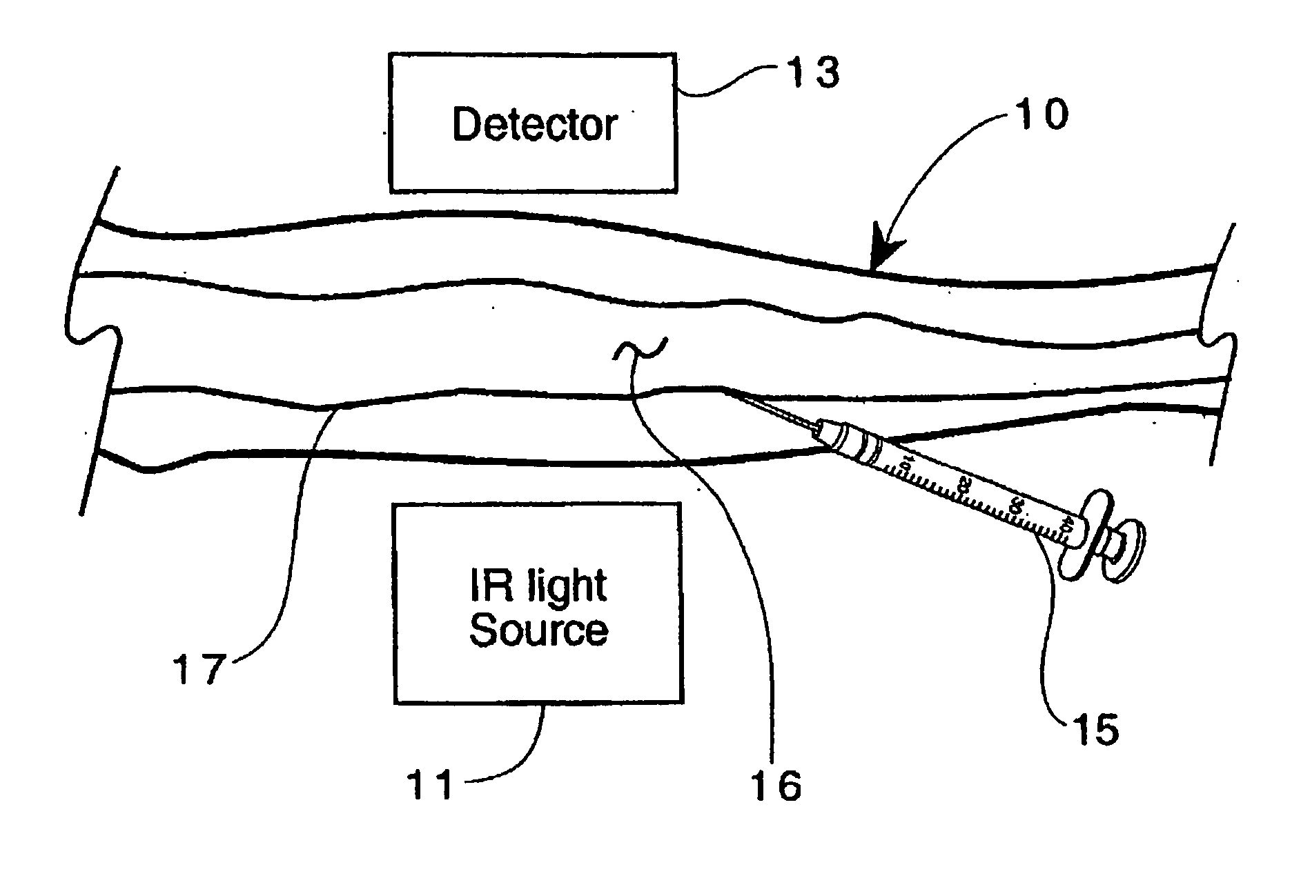 Method for detection and display of extravasation and infiltration of fluids and substances in subdermal or intradermal tissue