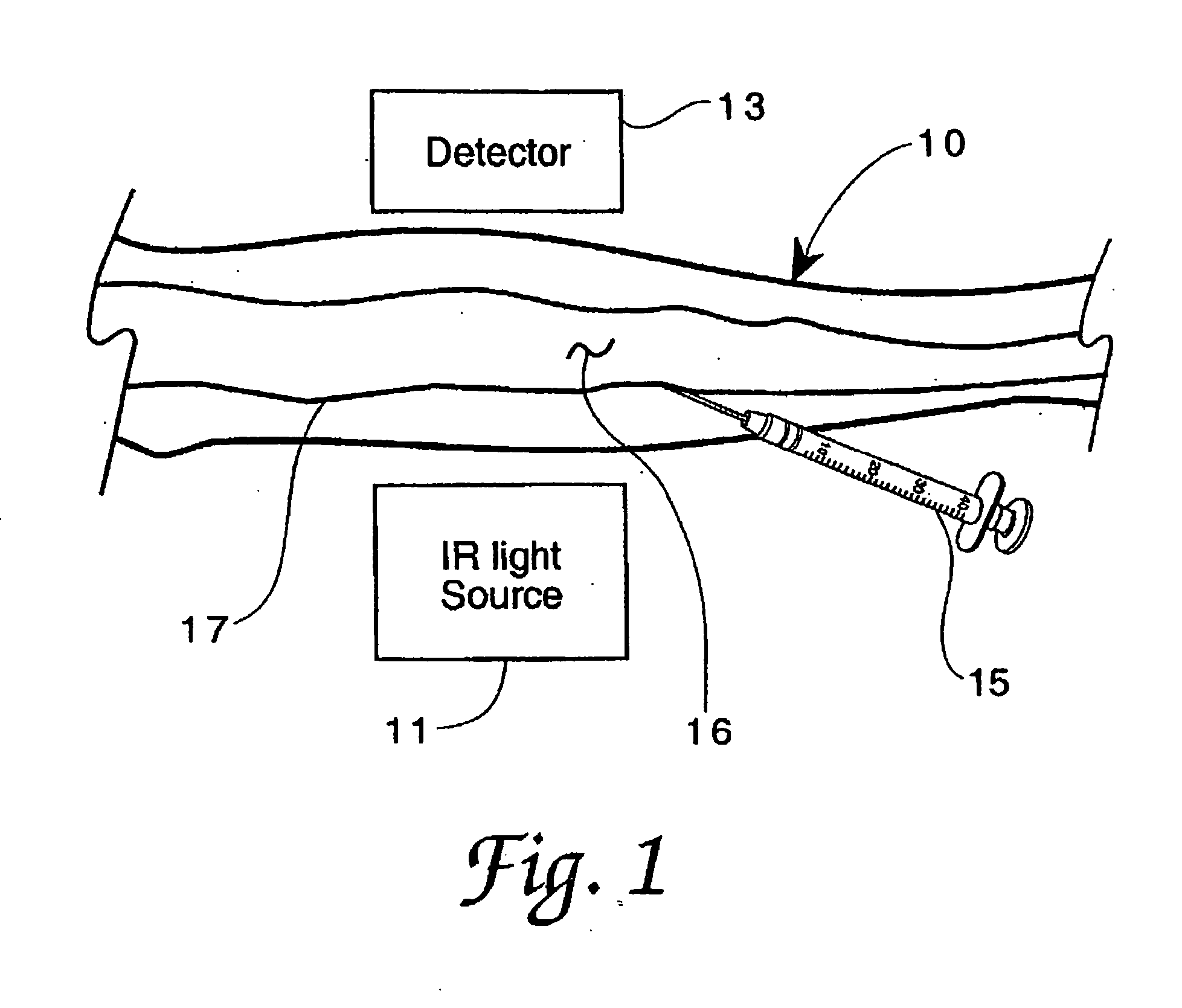 Method for detection and display of extravasation and infiltration of fluids and substances in subdermal or intradermal tissue