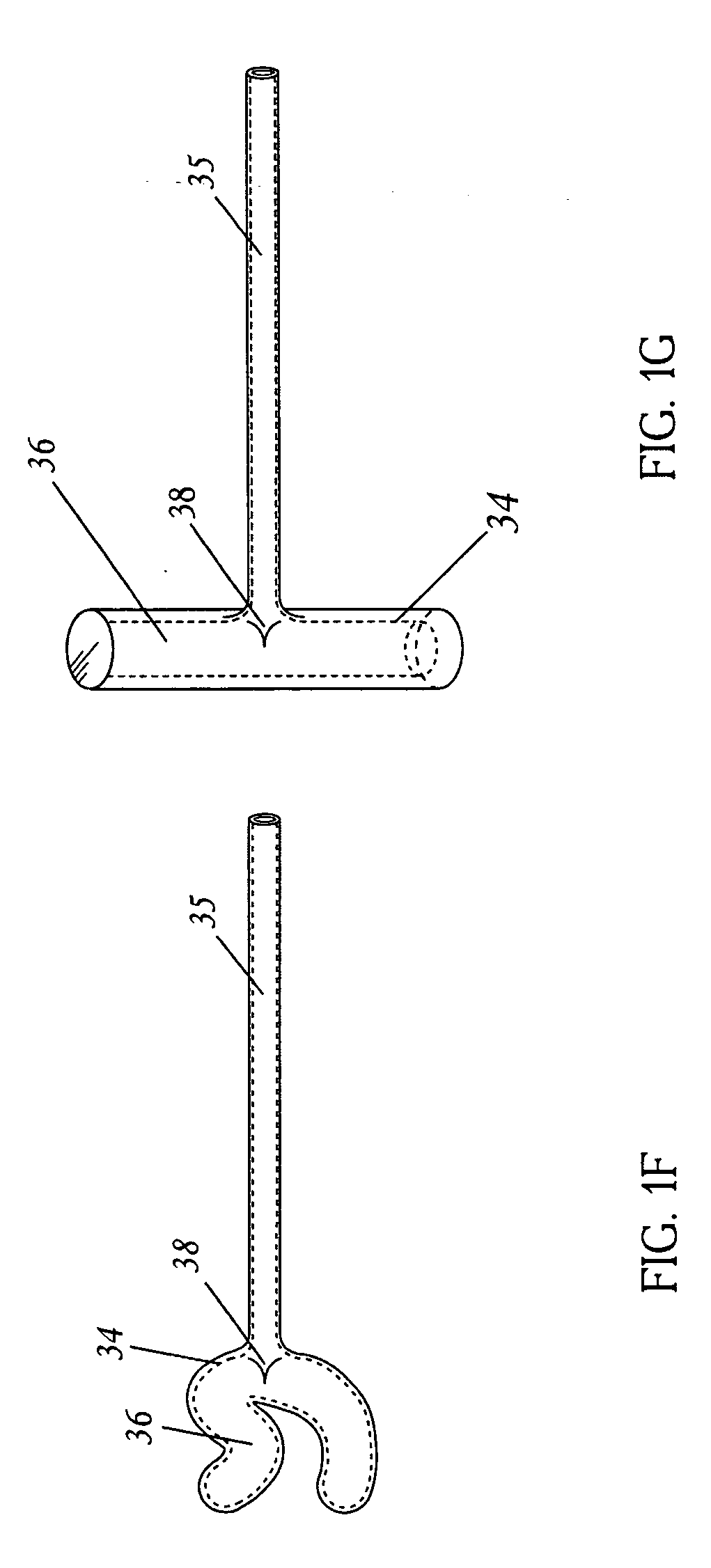 Methods and devices for combined gastric restriction and electrical stimulation